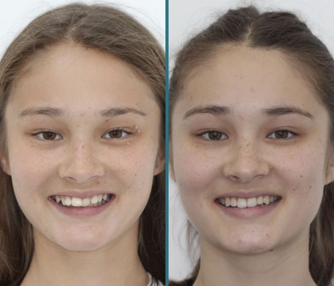 Overbites Before After 1