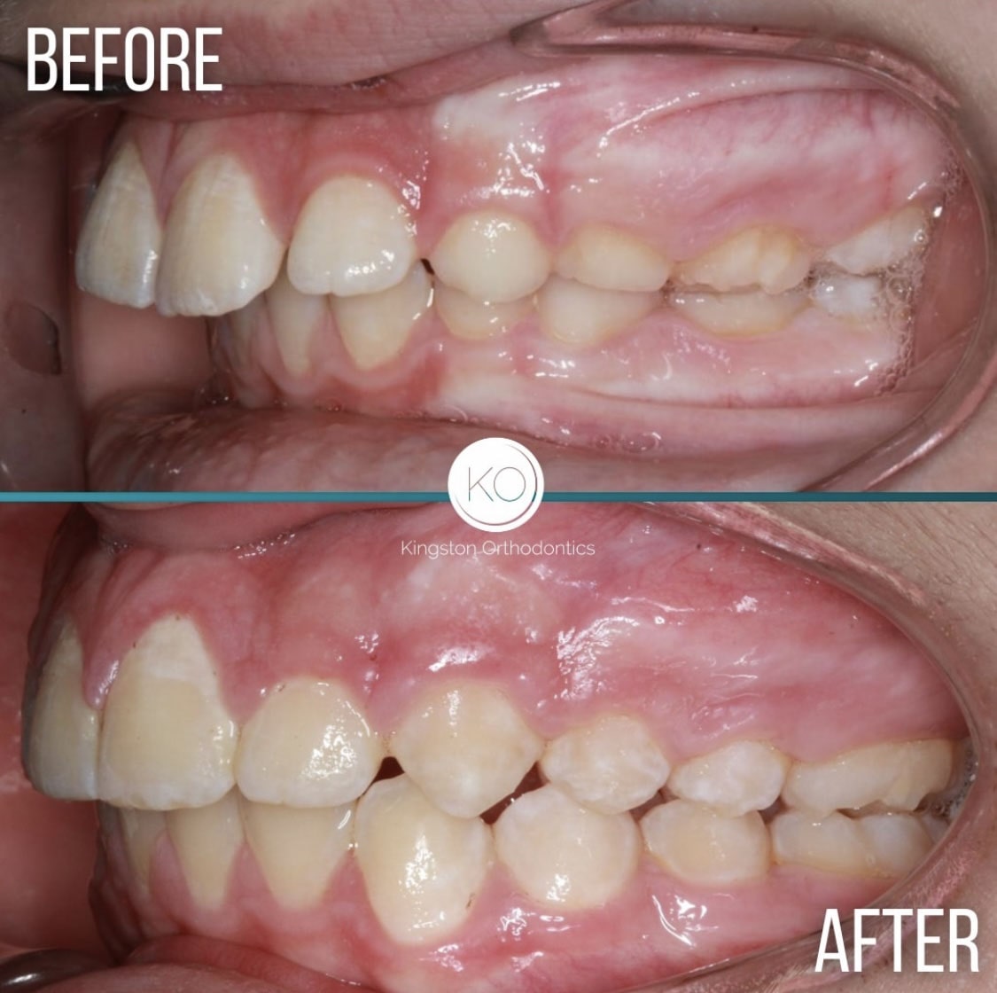 Overbites Before After 10