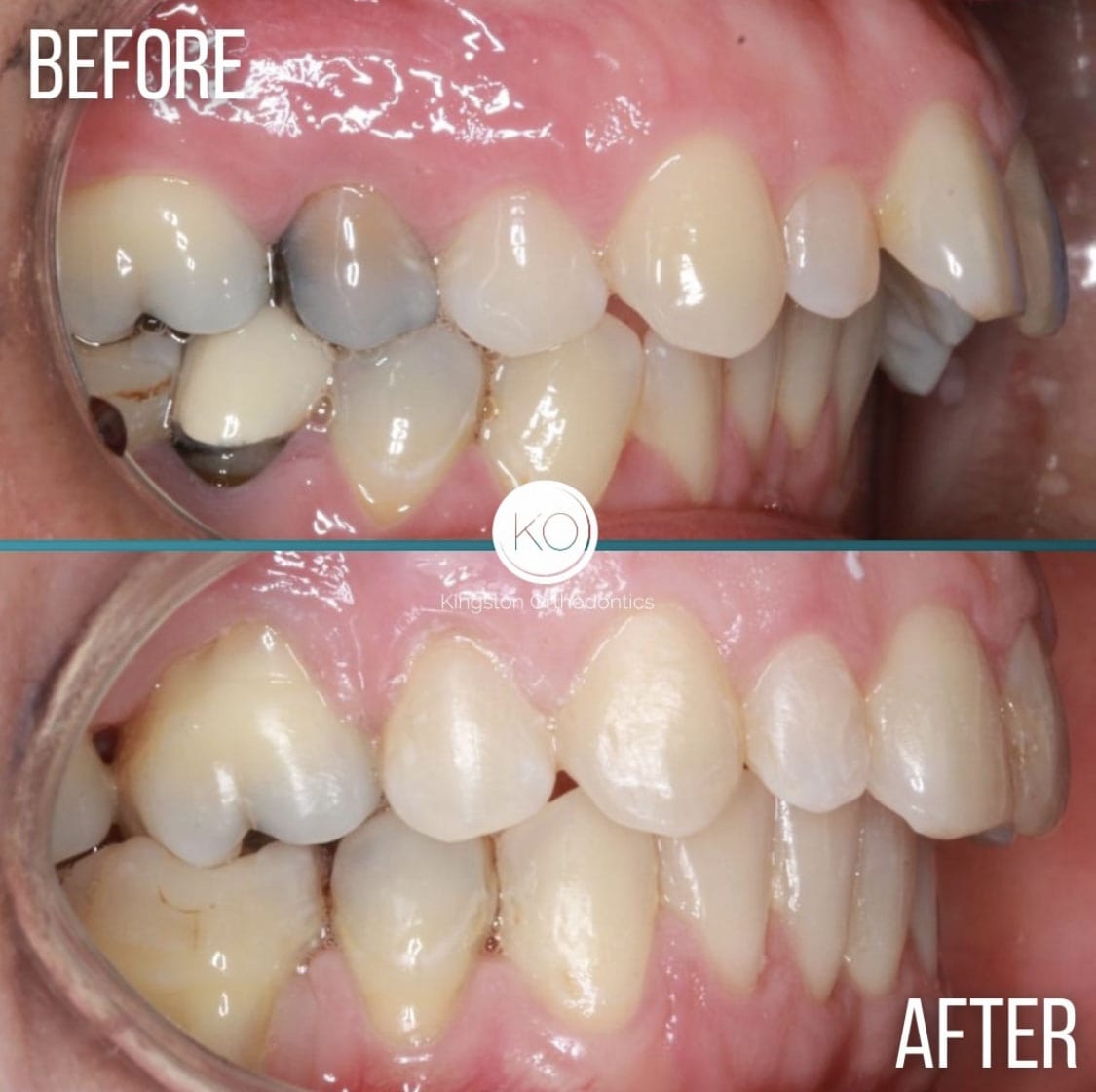 Overbites Before After 11