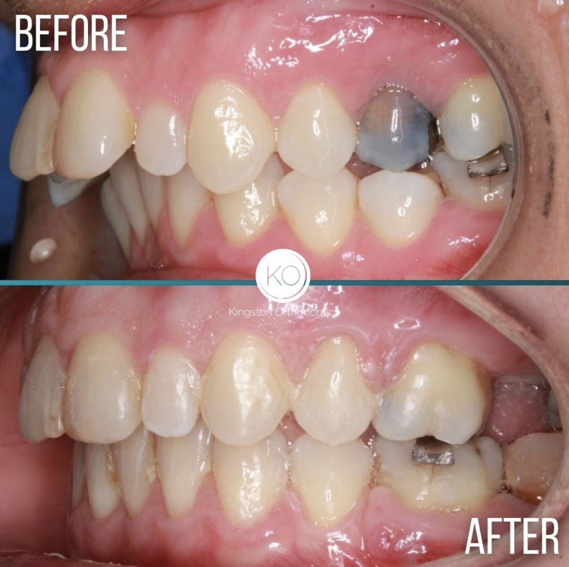 Overbites Before After 12