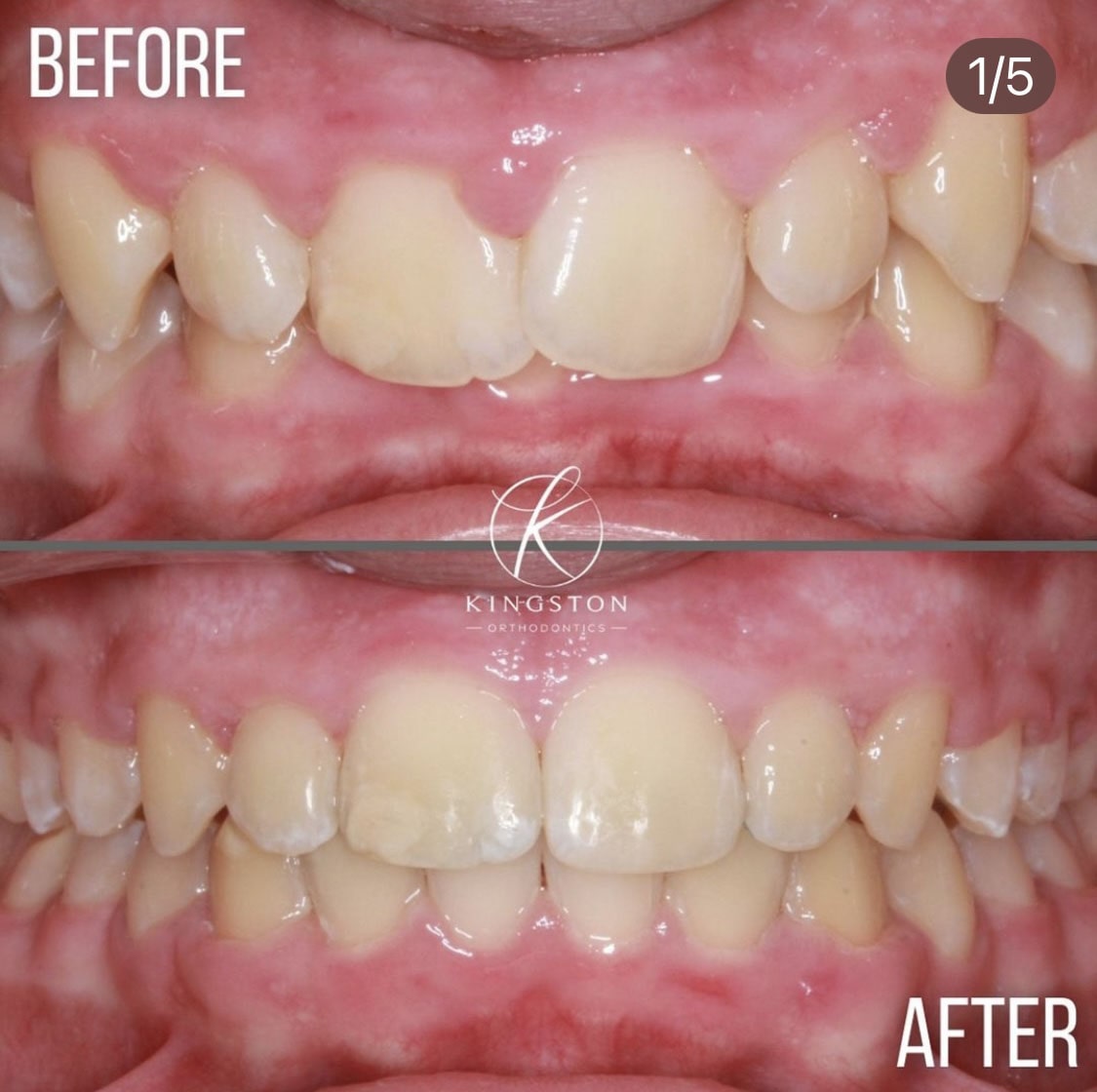 Overbites Before After 13