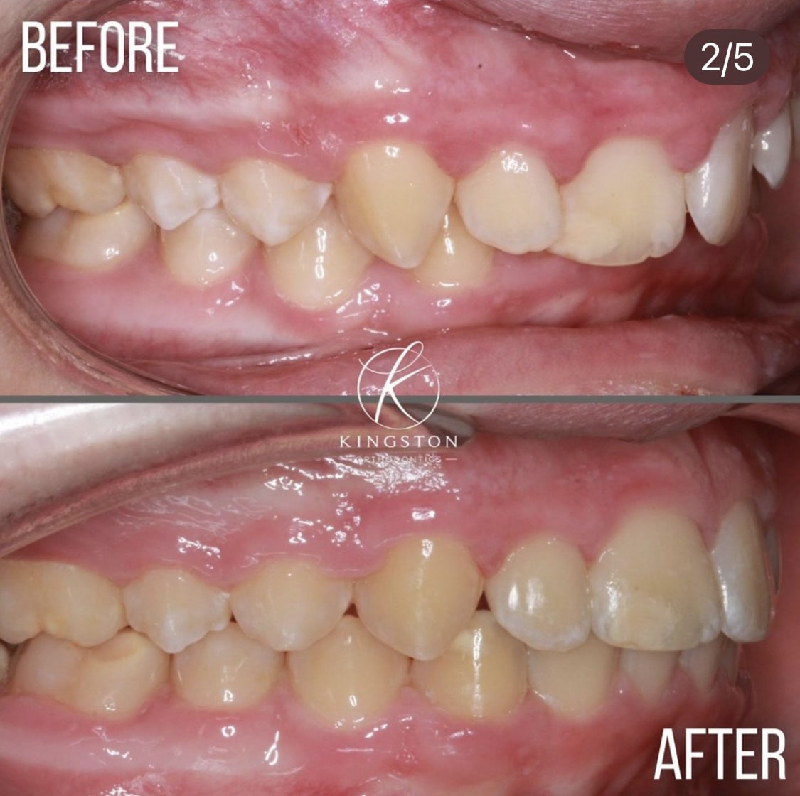 Overbites Before After 14