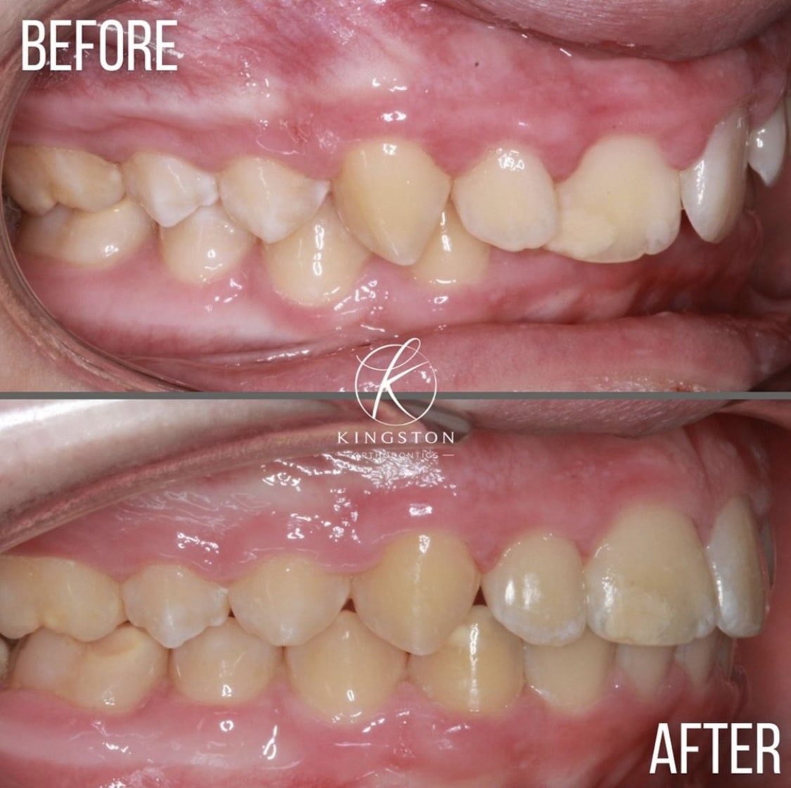 Overbites Before After 15