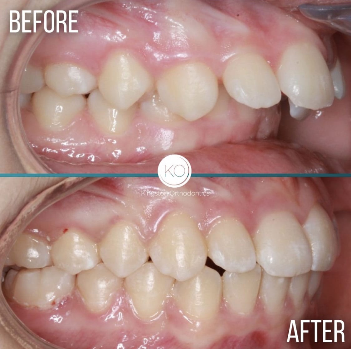 Overbites Before After 4