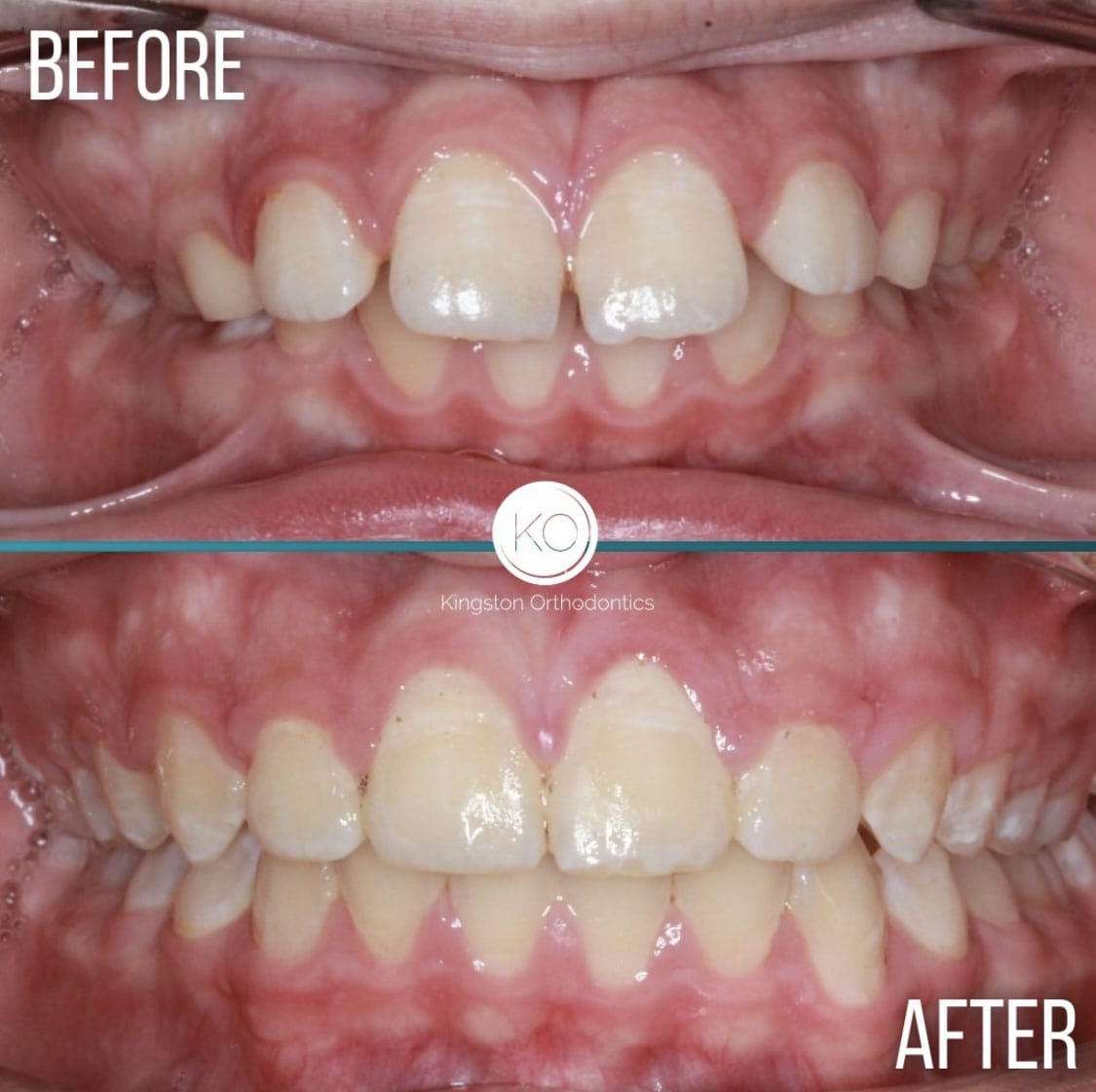 Overbites Before After 8