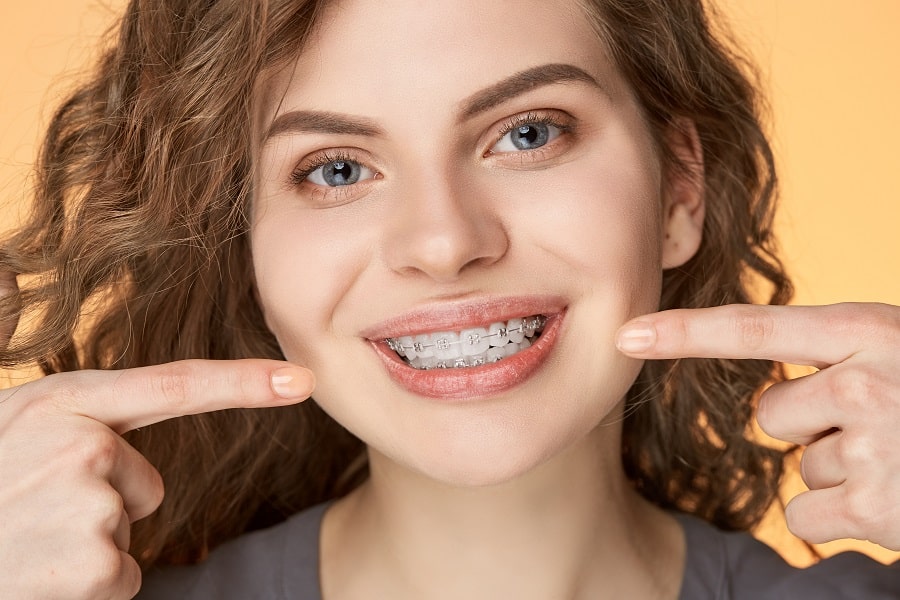 Ceramic Braces