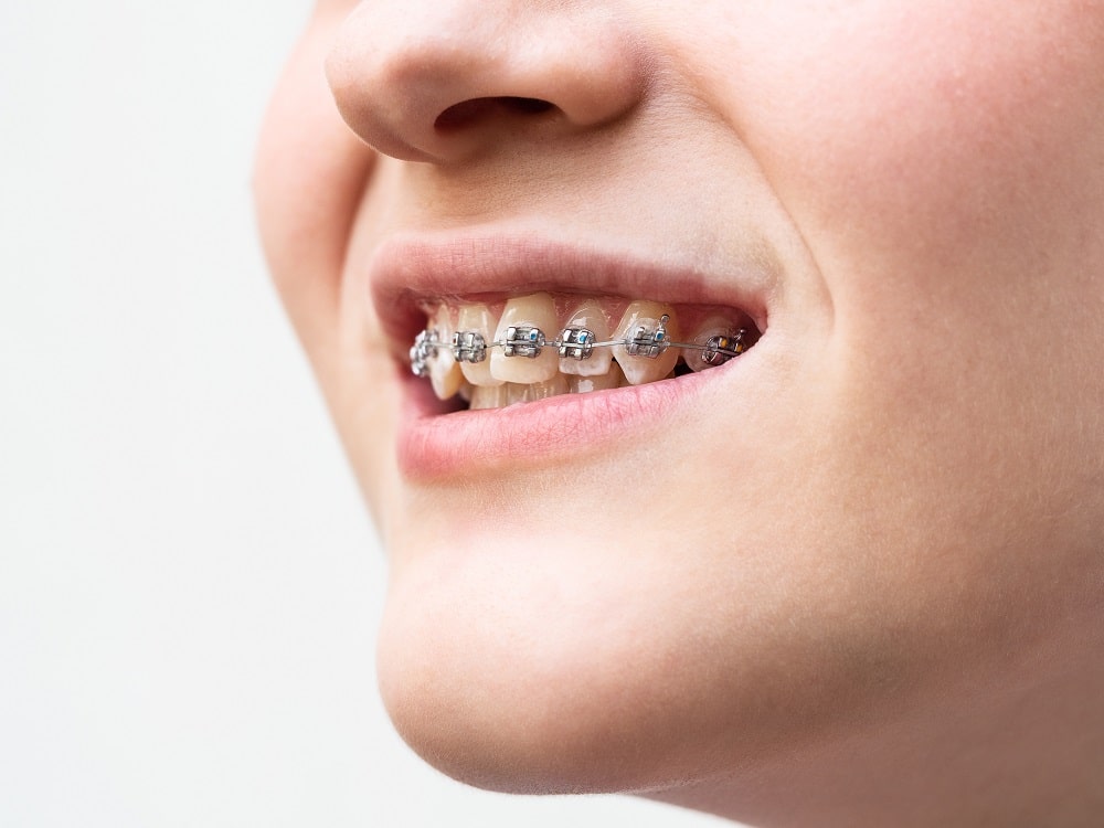 Fixed Braces