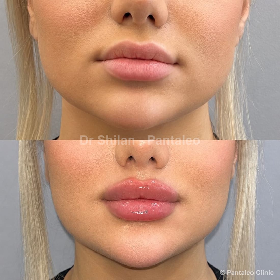 Lip filler before and after in London, treated by Dr Shilan Mirian