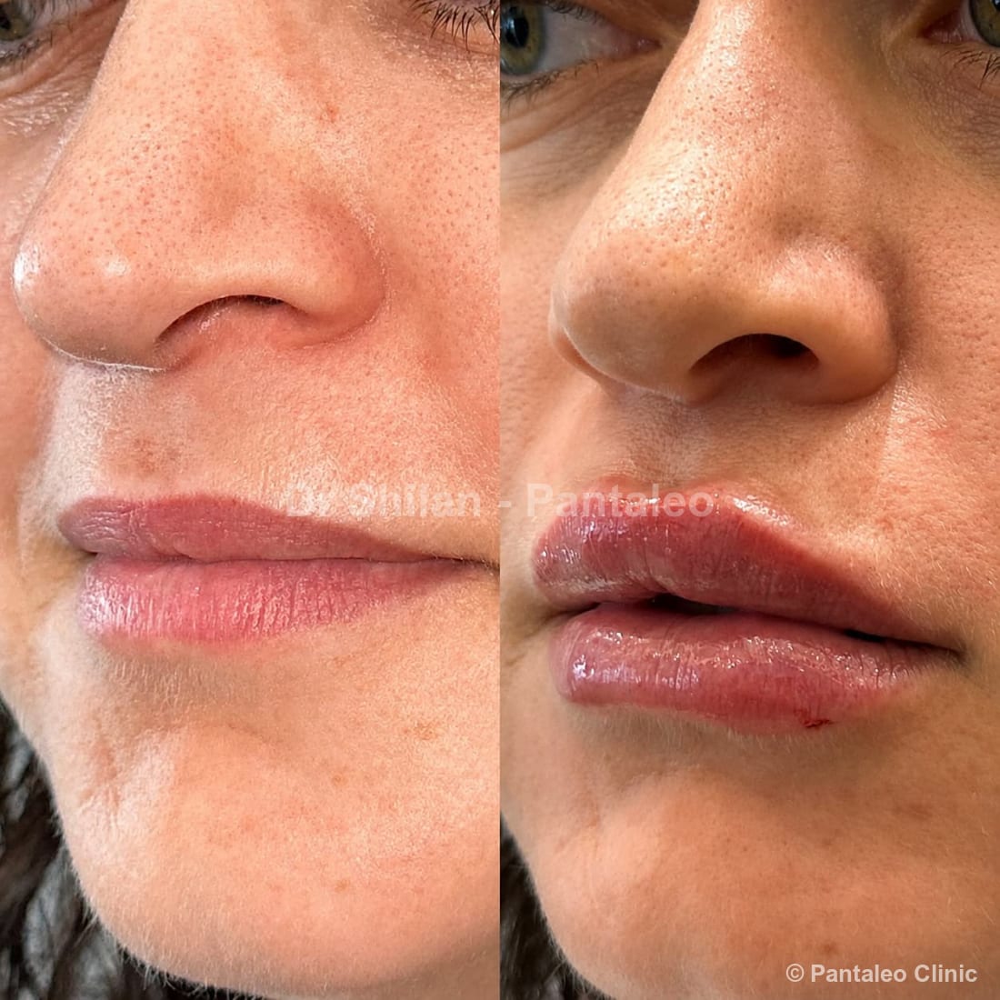 Lip filler before and after — female patient, treated by Dr Shilan Mirian