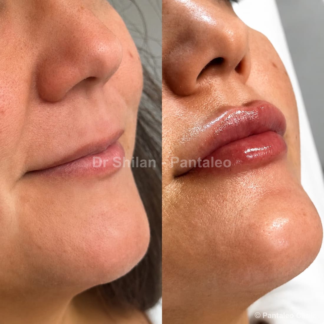 Lip filler before and after — female patient, treated by Dr Shilan Mirian