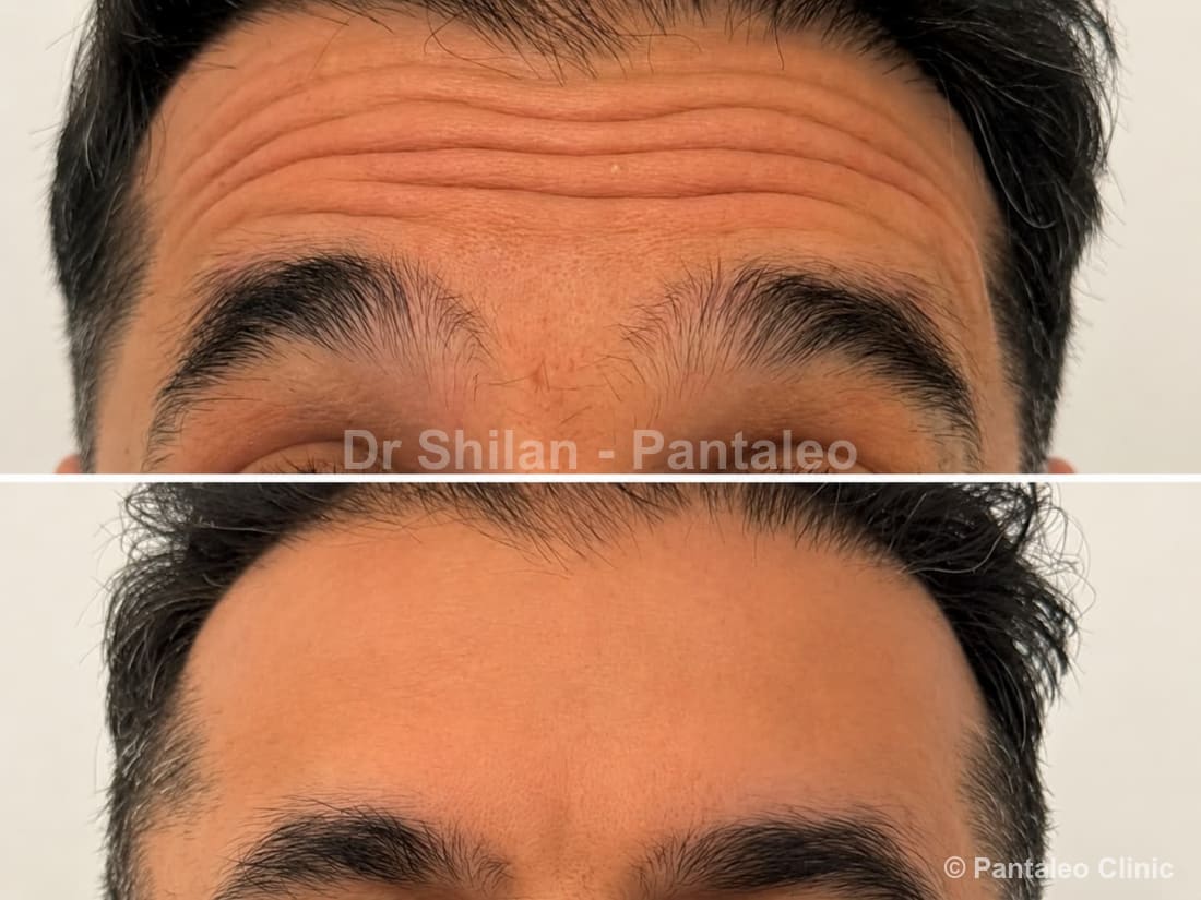 Anti-wrinkle (Botox) before and after — male patient, treated by Dr Shilan Mirian