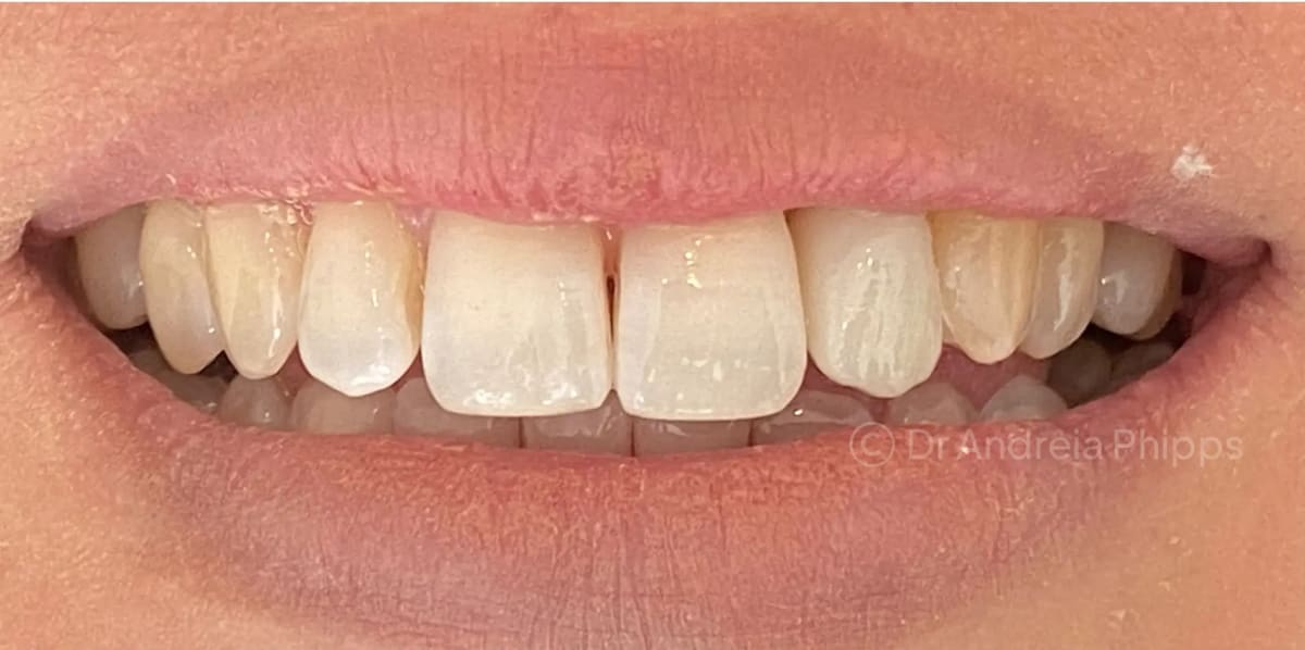 After treatment