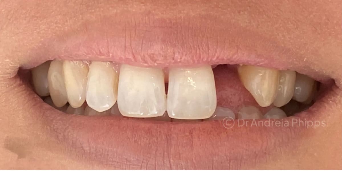 Before treatment