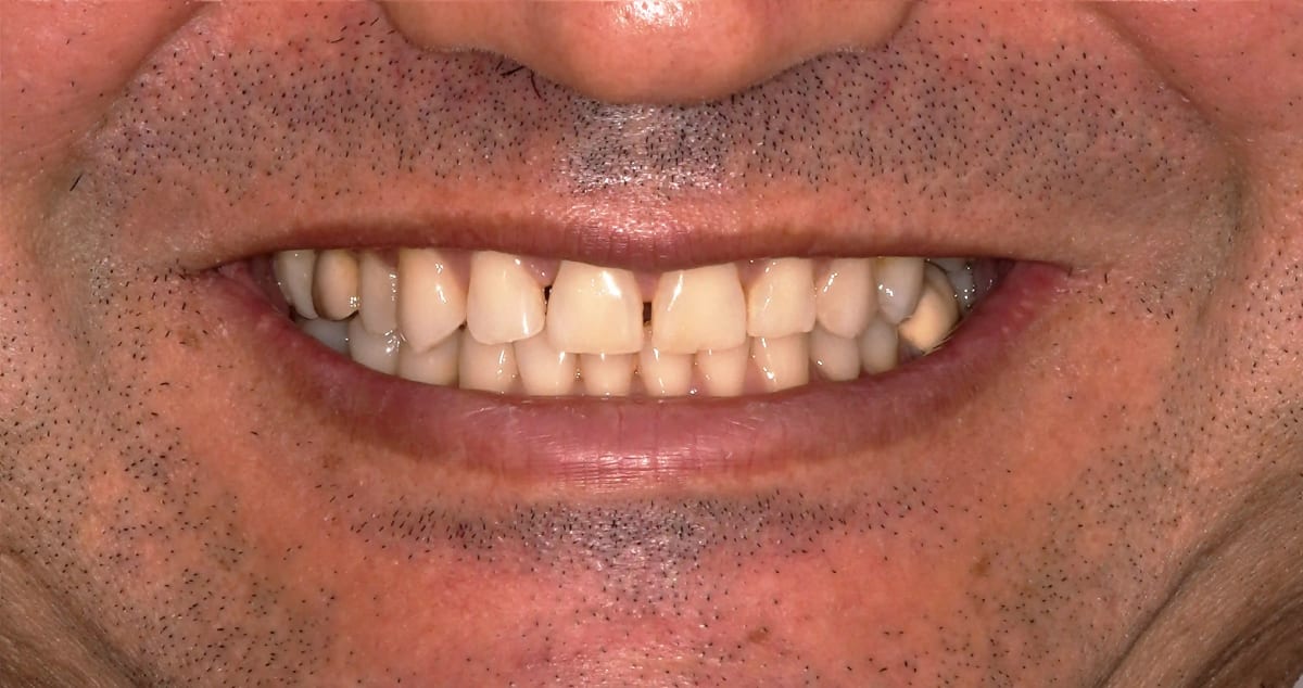 Before Trial Smile Preview (Digital Smile Design)