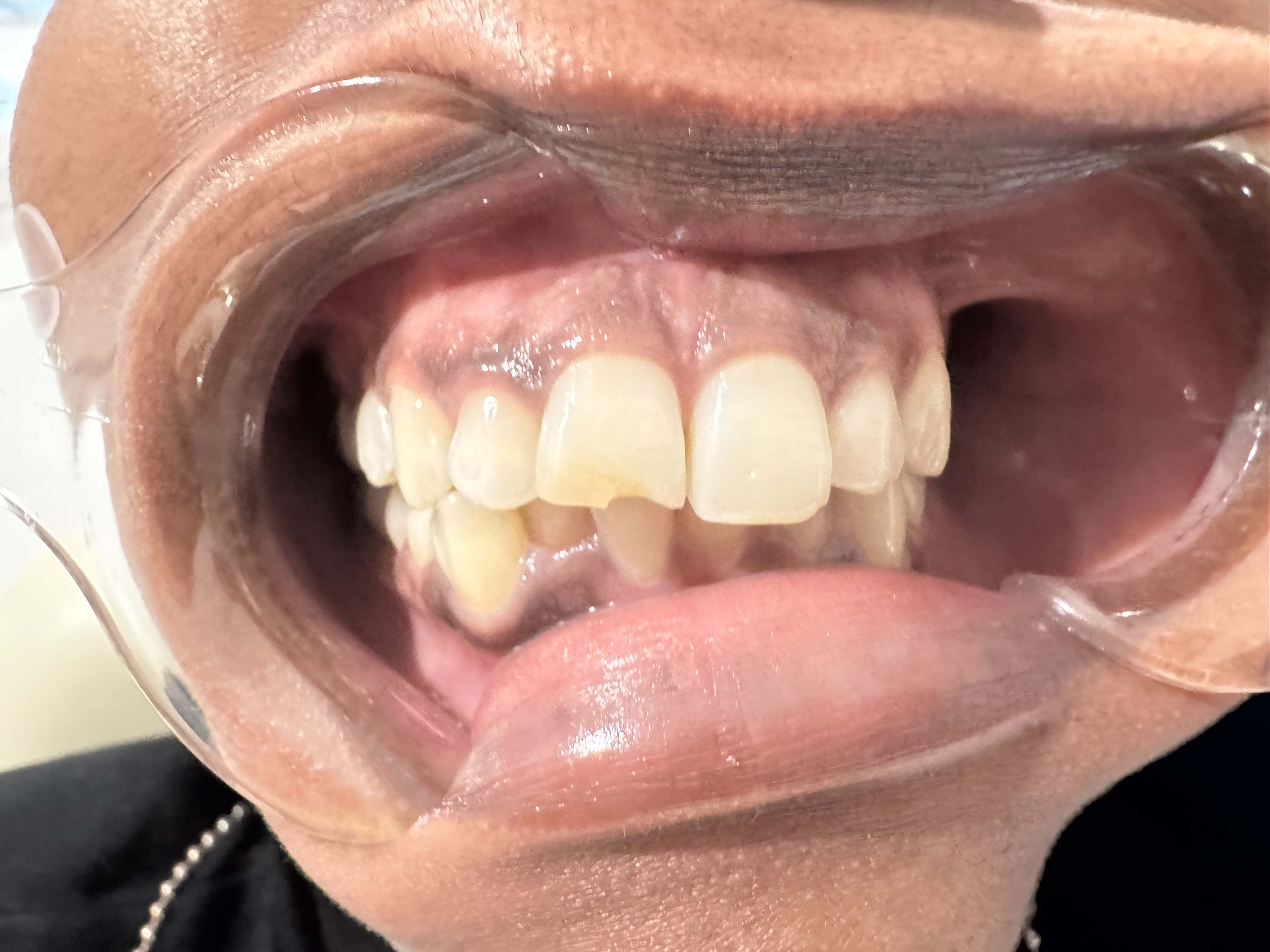 Before: Chipped front tooth