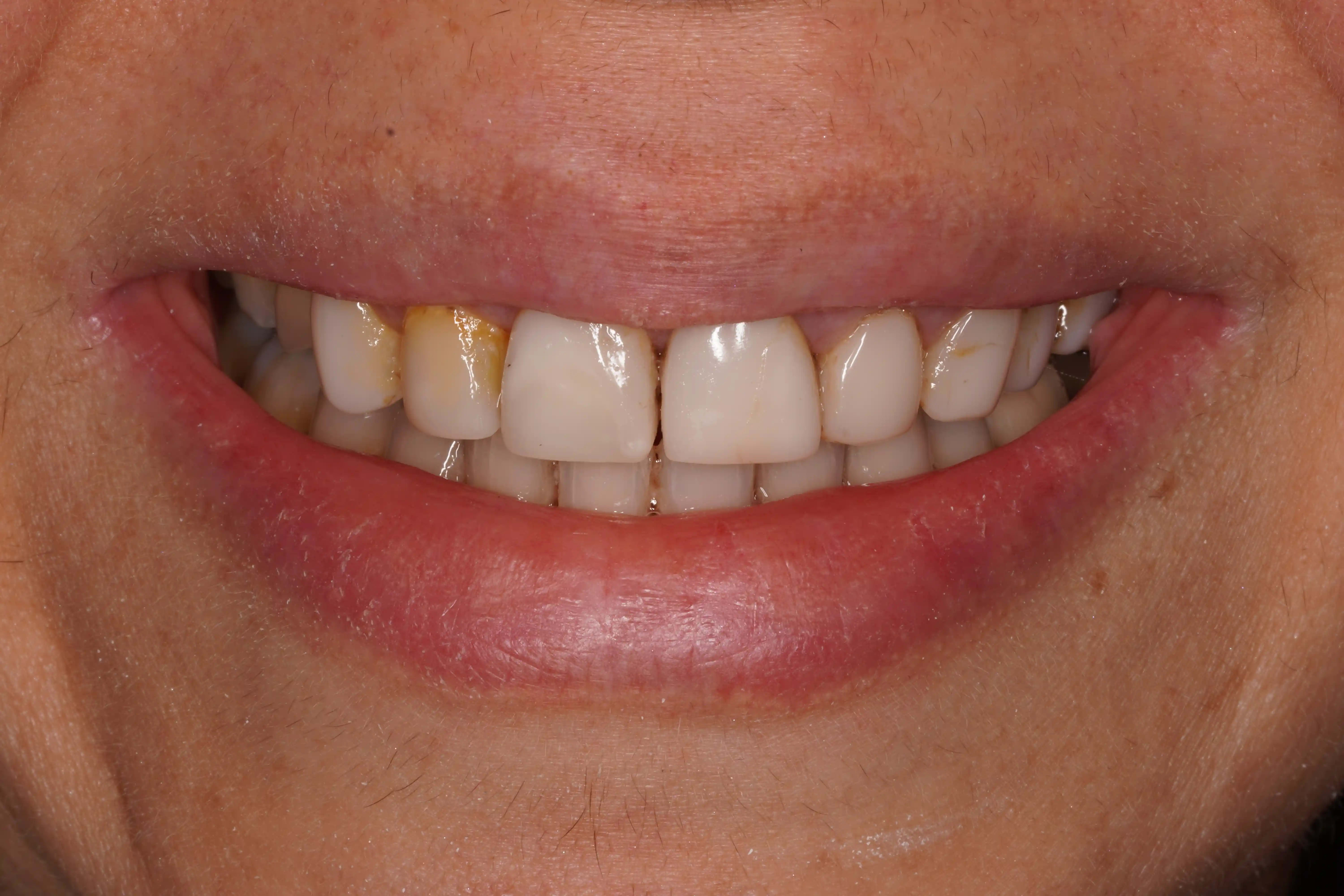After Composite Bonding