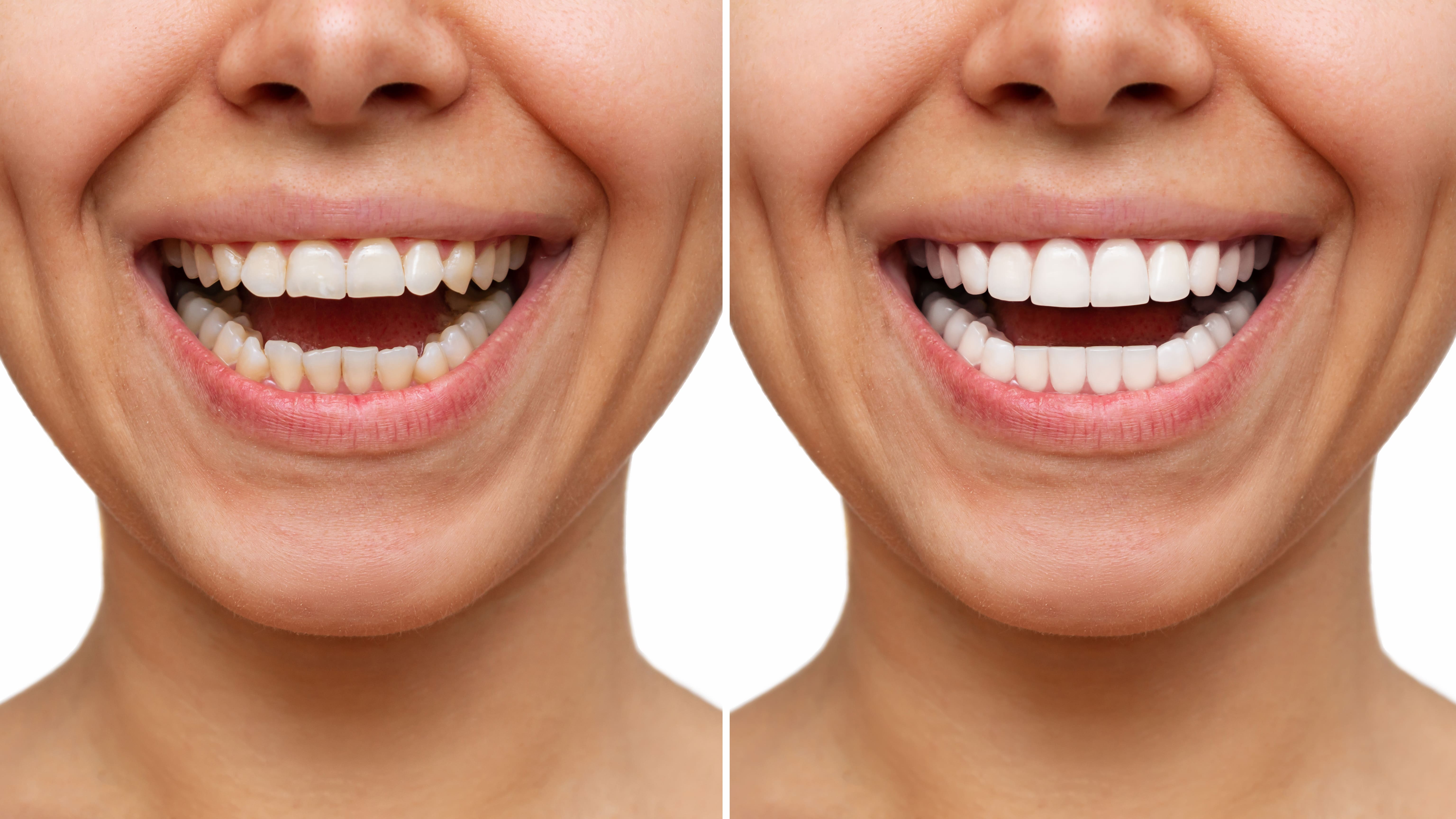 Porcelain Veneers - professional dental treatment in South Kensington