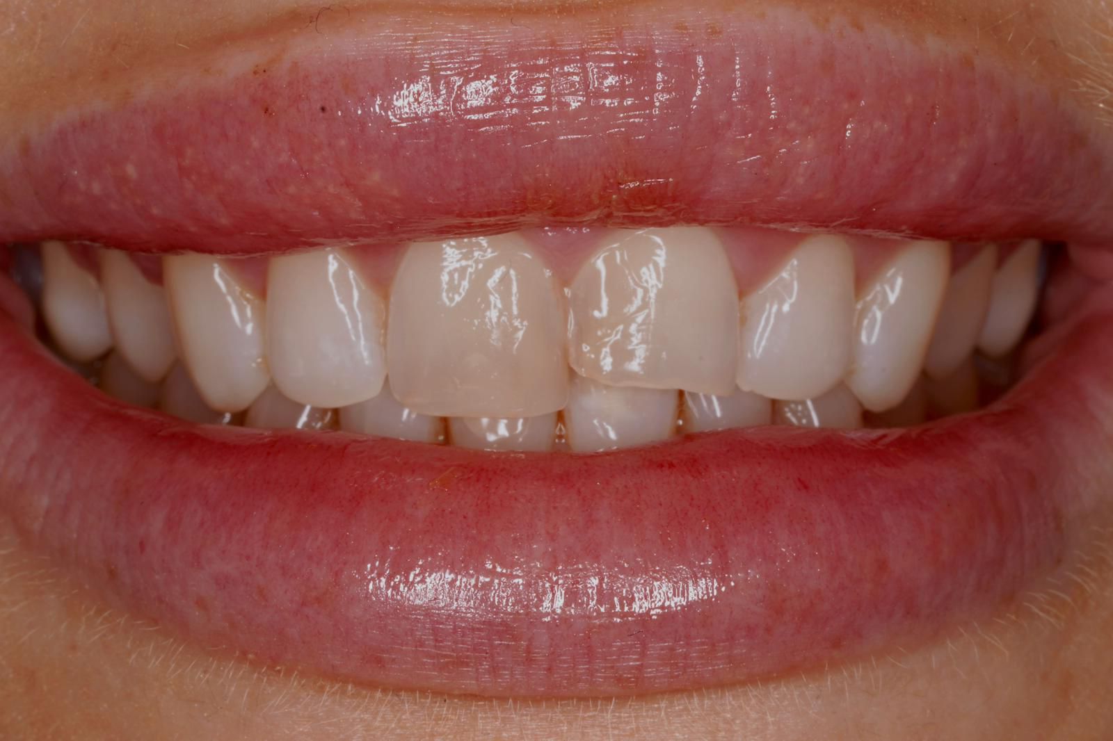 Before Restoring a Chipped Front Tooth - patient presentation