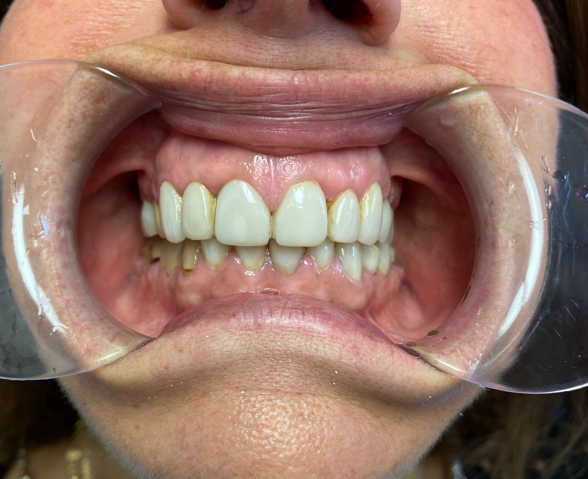 Before Porcelain Veneers & Crowns