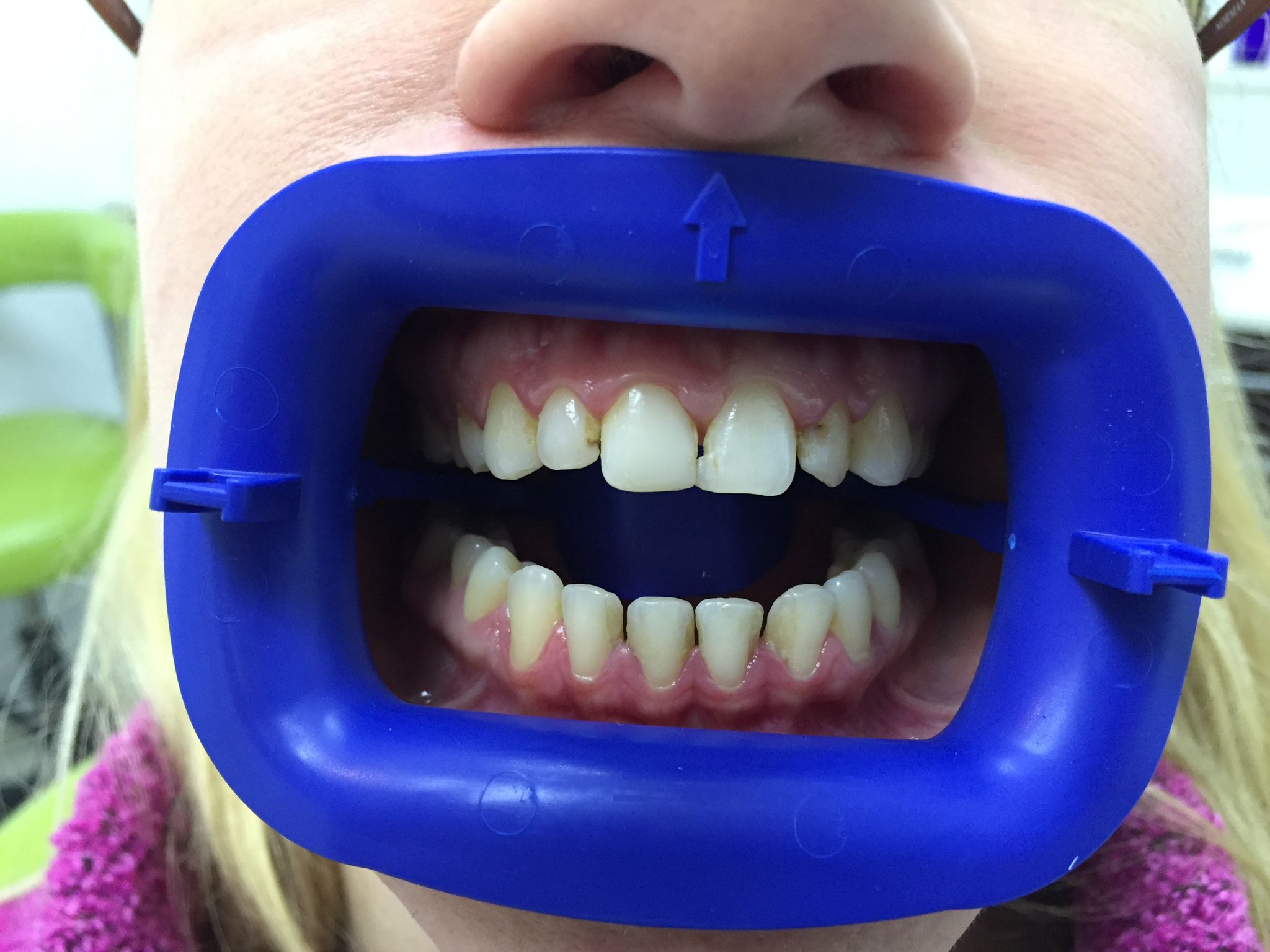 Before Porcelain Veneers