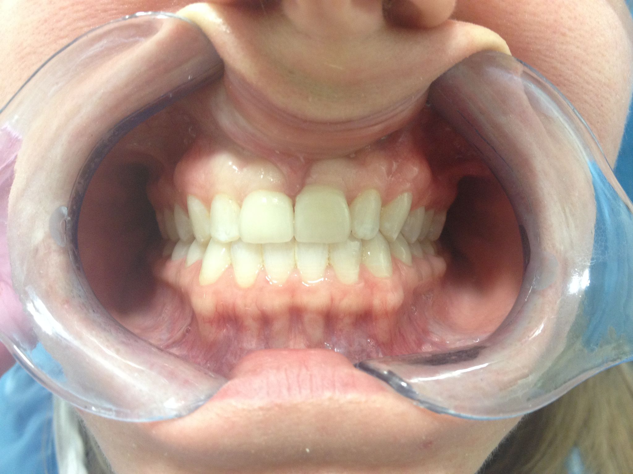 After Porcelain Veneers