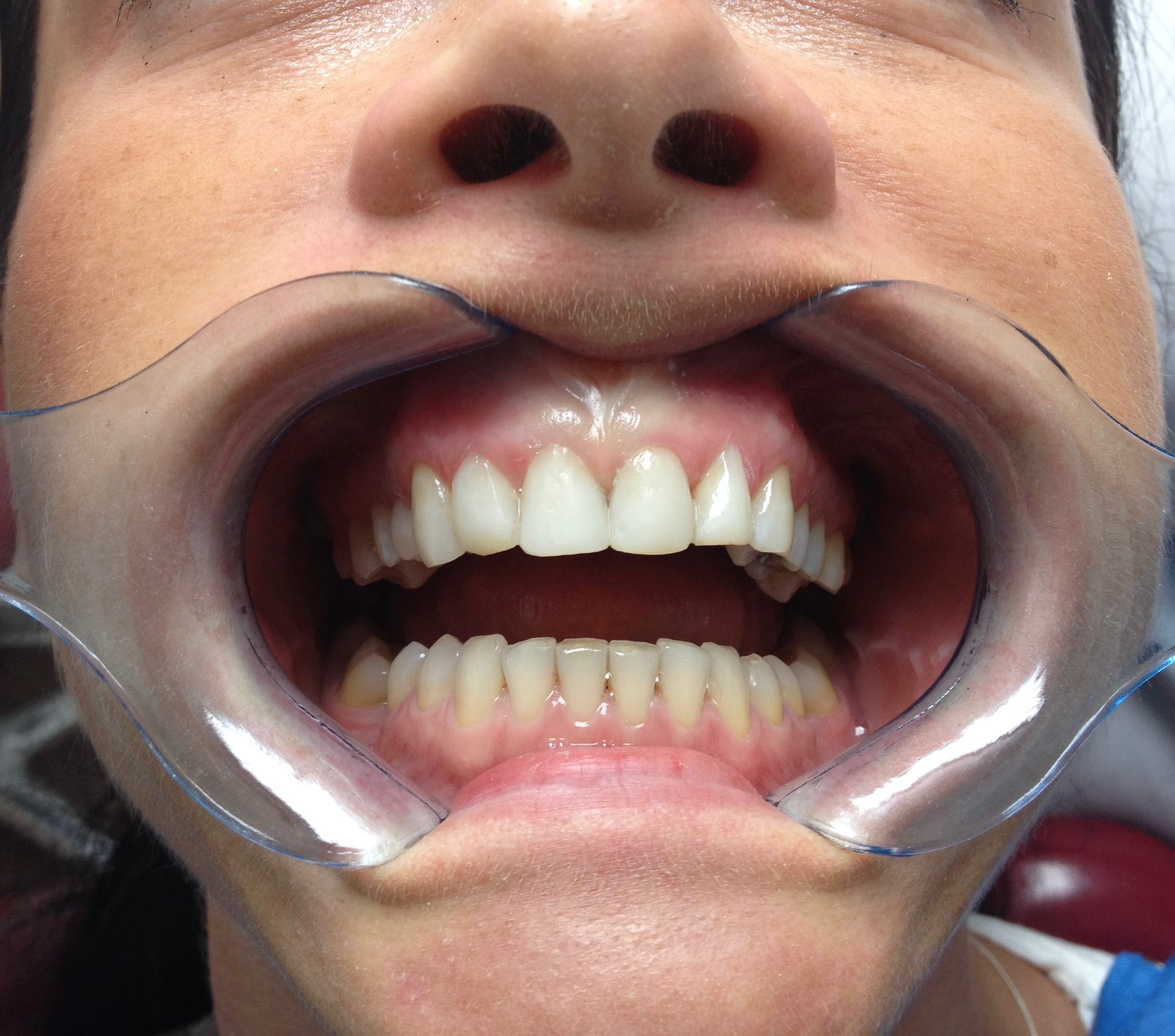 After Transforming Discoloured & Chipped Teeth - dental transformation result