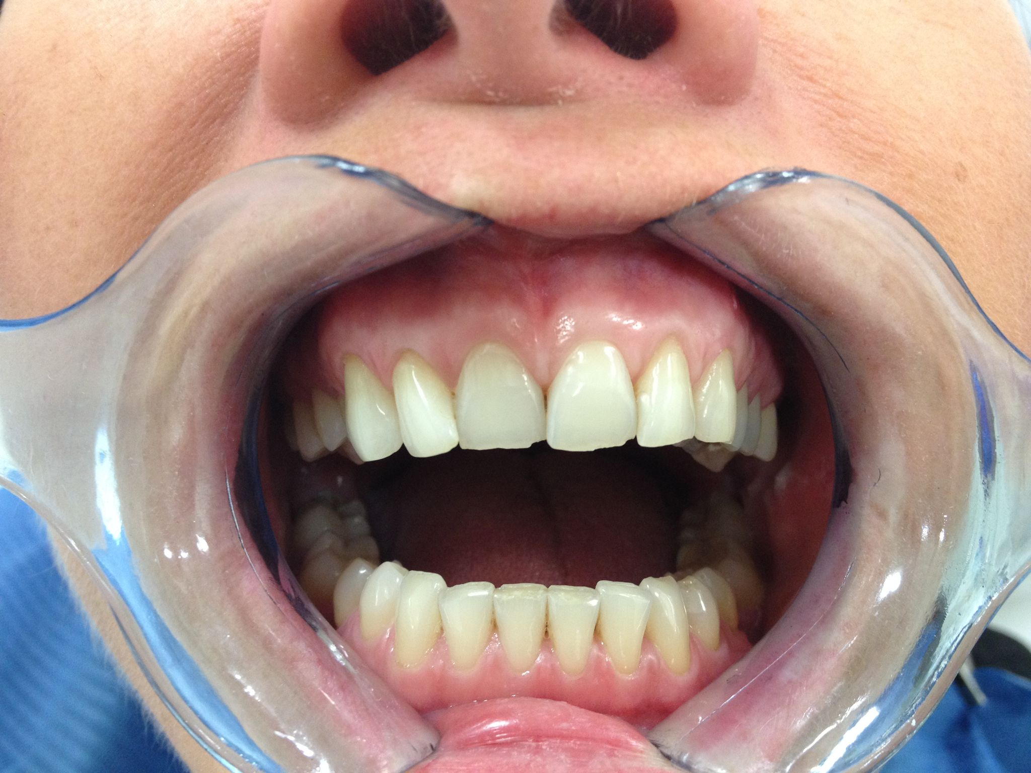 Before Transforming Discoloured & Chipped Teeth - patient presentation