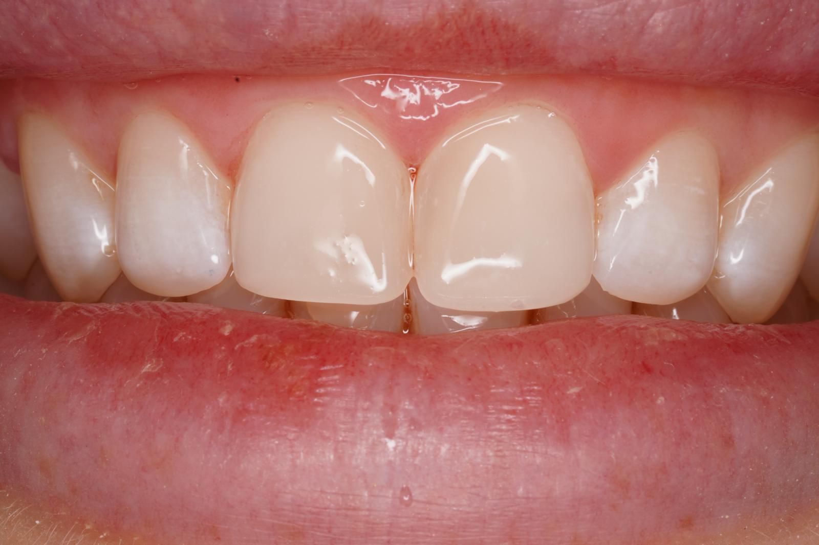 After Restoring a Chipped Front Tooth - dental transformation result