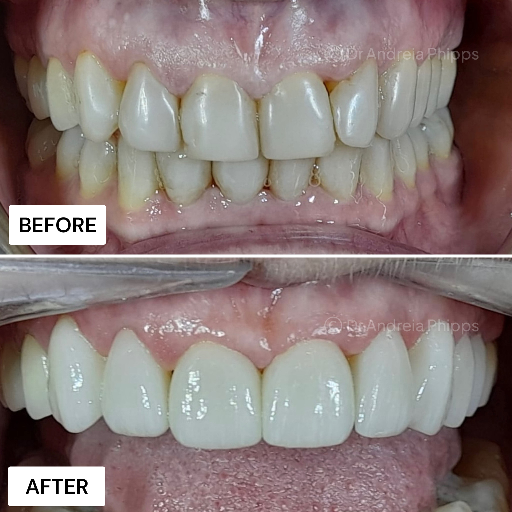 Transformation Case 47