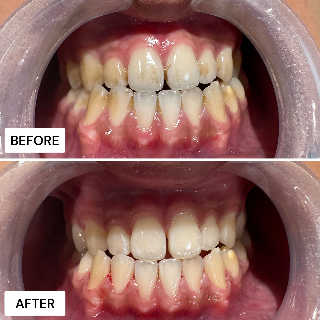 AirFlow Teeth Cleaning Results London
