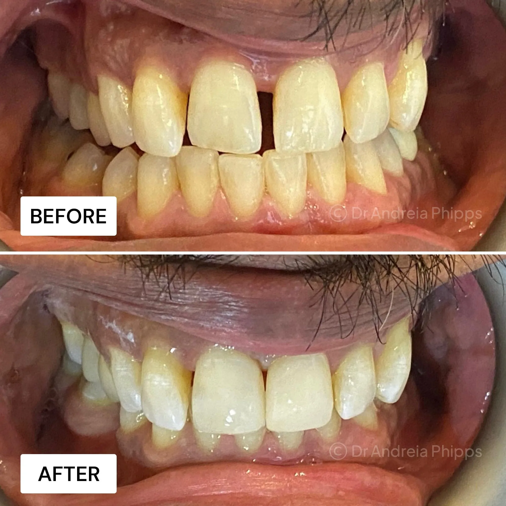 Transformation Case 45