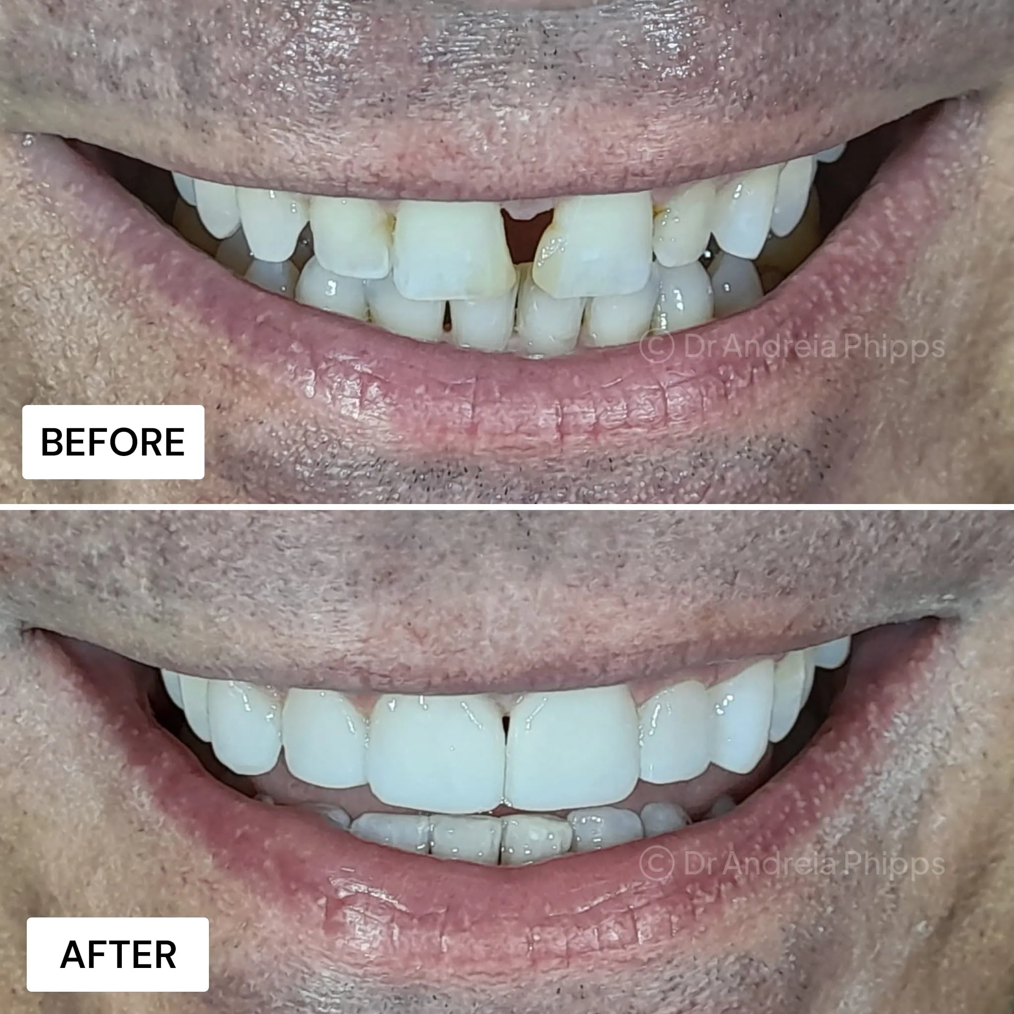 Transformation Case 44