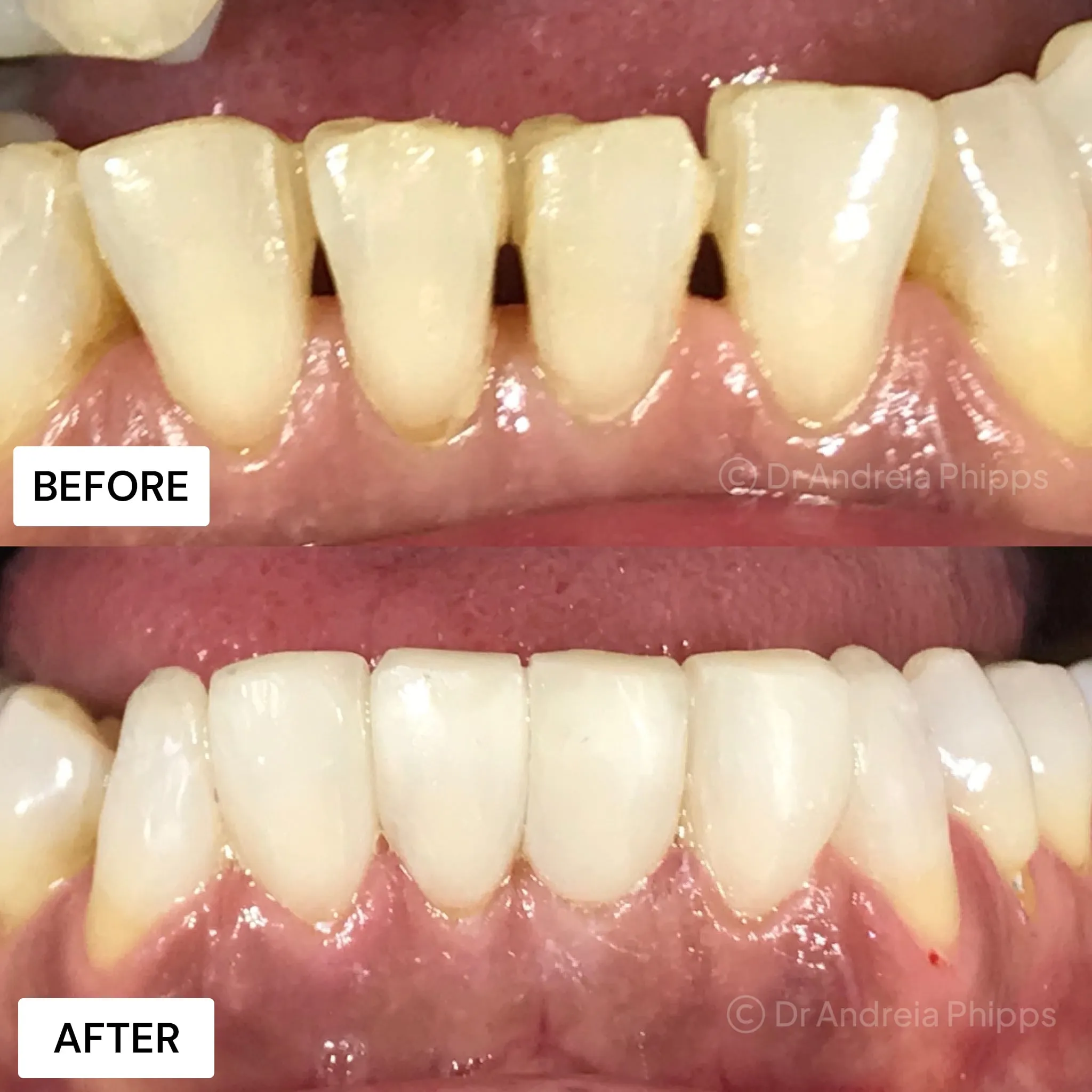 Composite Bonding - Before and After