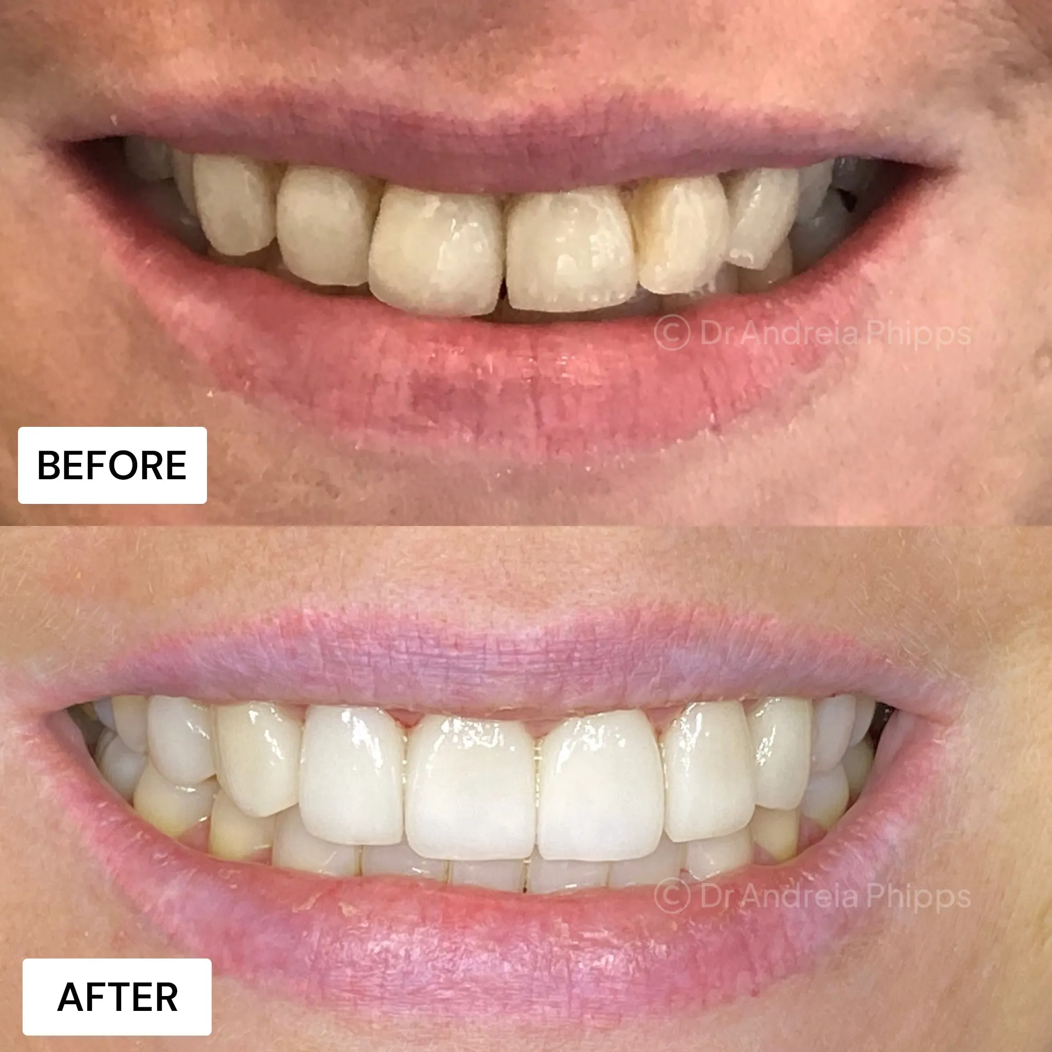 Transformation Case 43