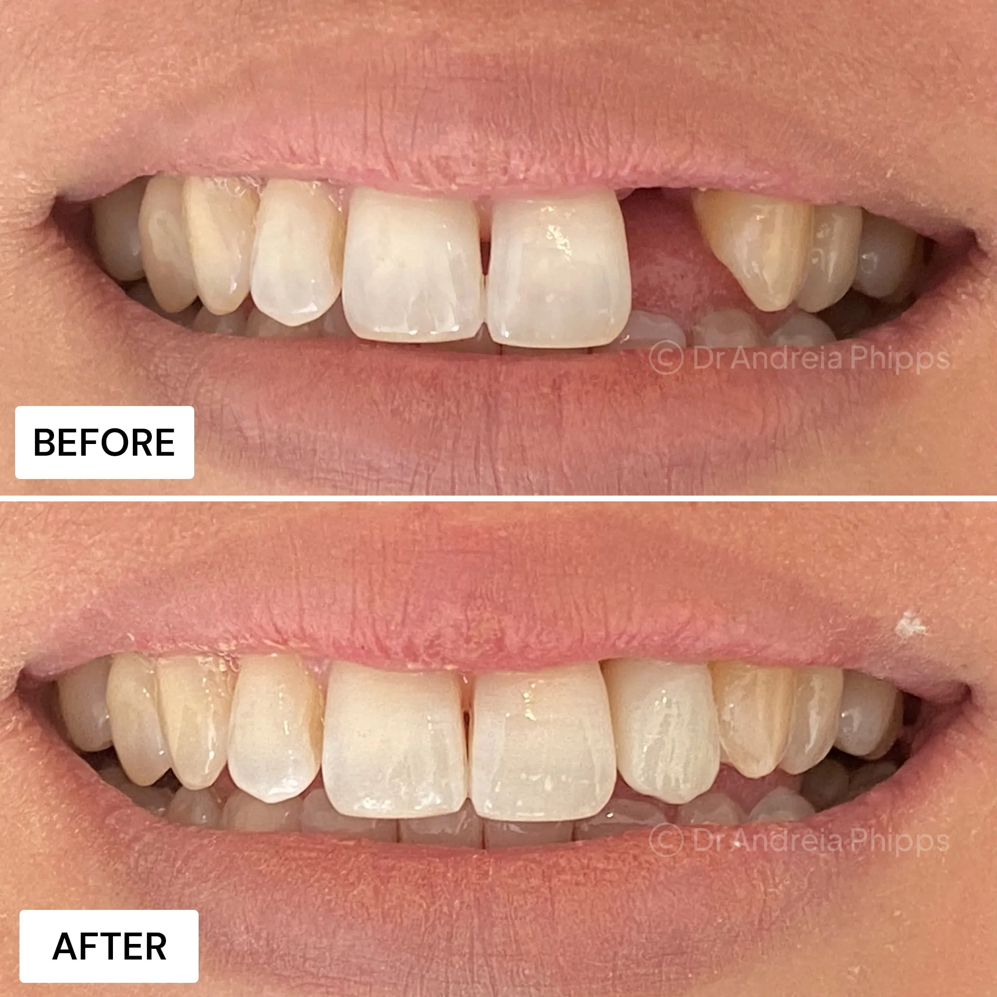 Transformation Case 42