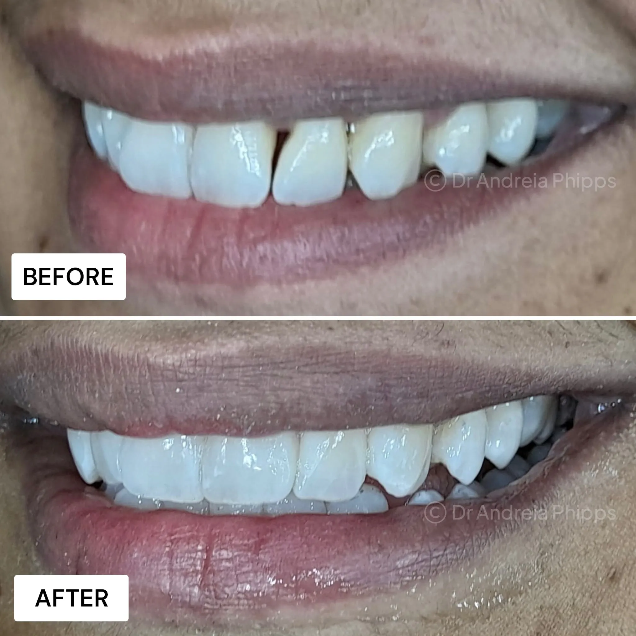 Composite Bonding - Before and After