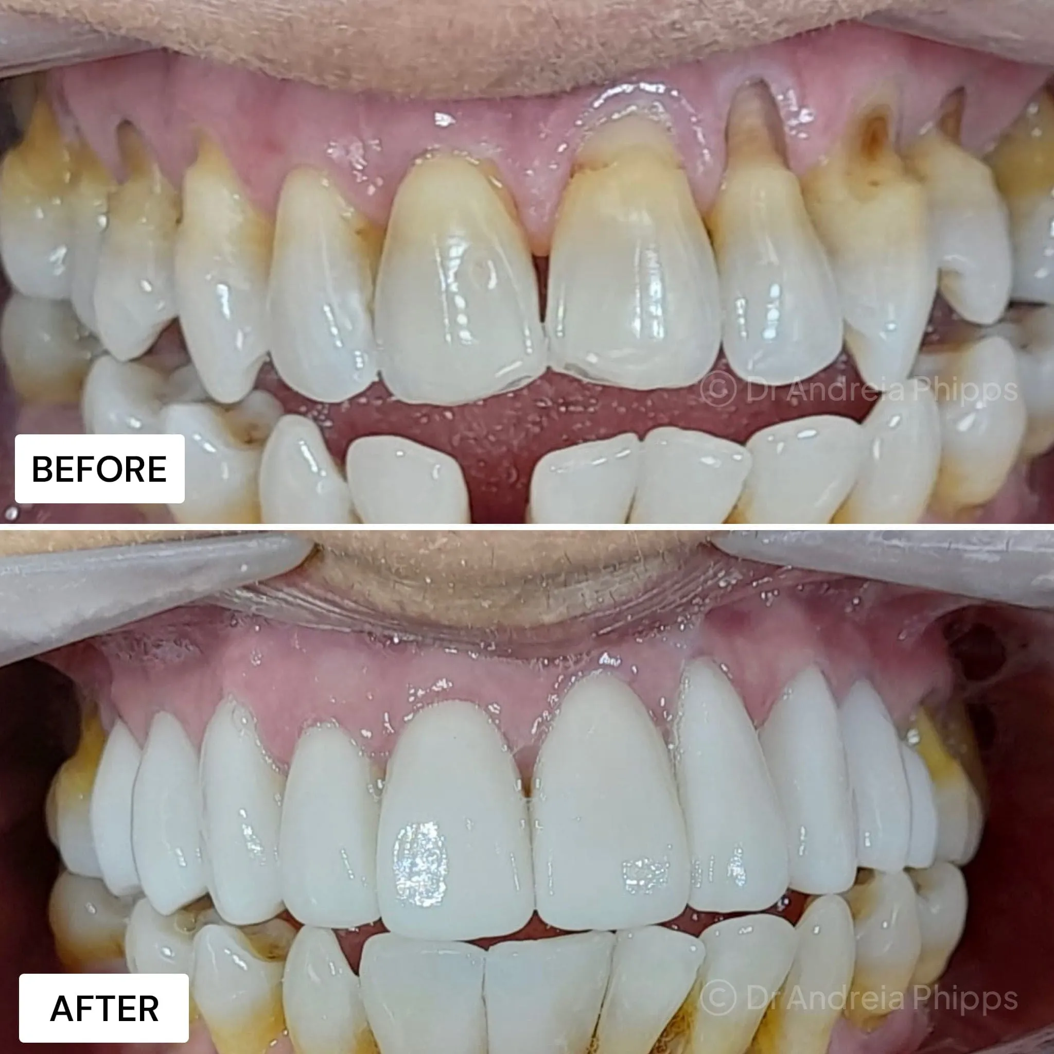 Transformation Case 38