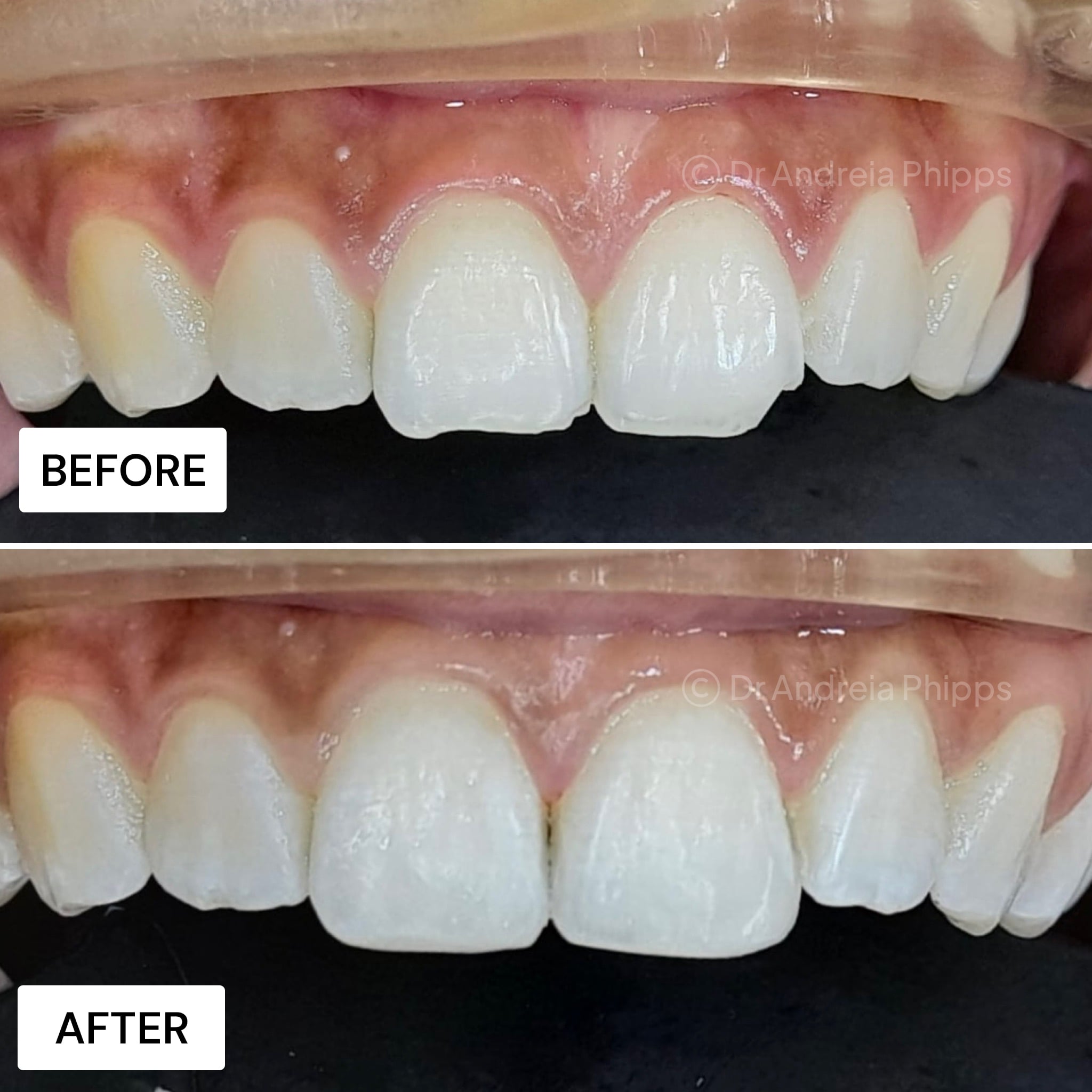 Transformation Case 57