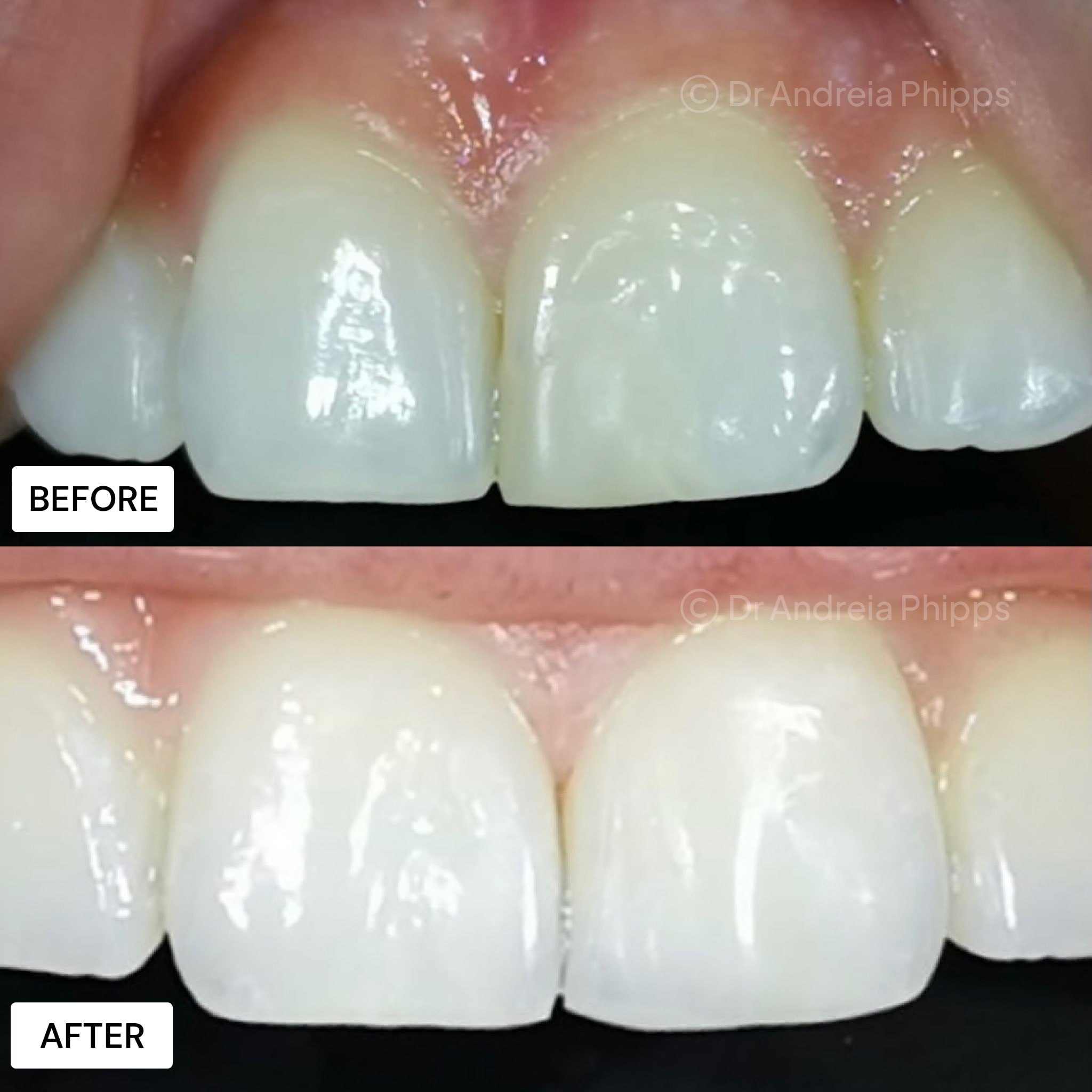 Transformation Case 56