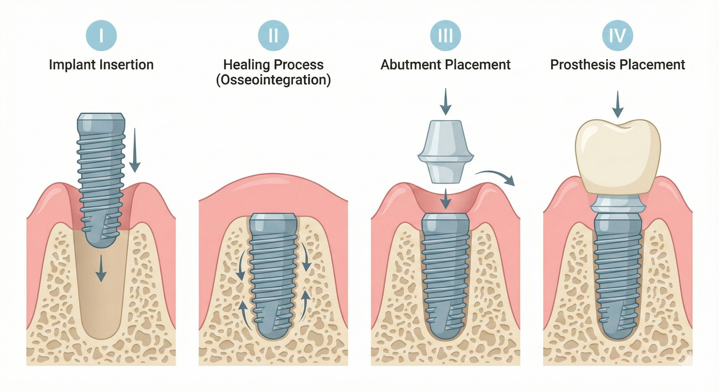 Dental Implant Process Stages
