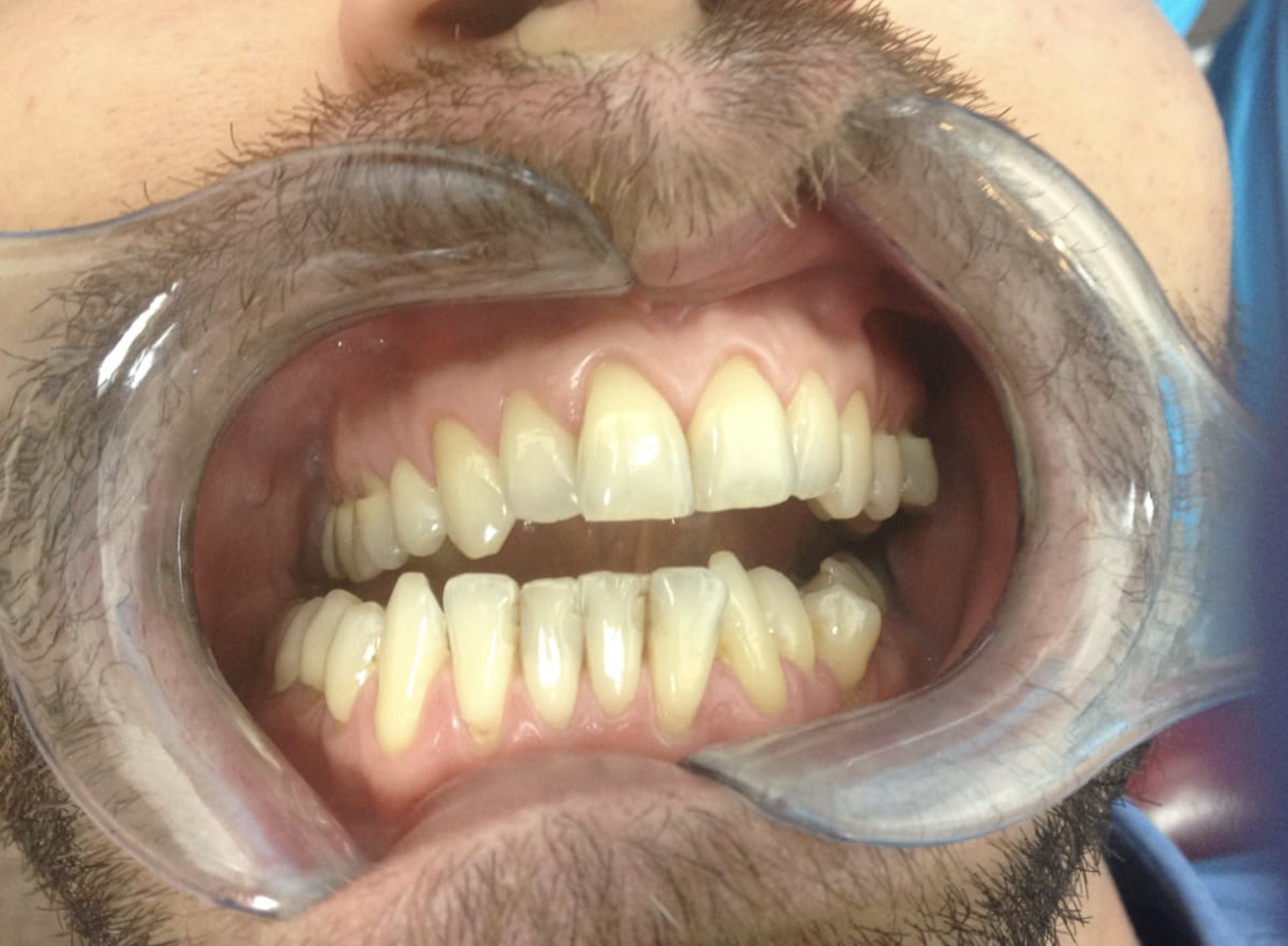 Home Teeth Whitening Before Case 1