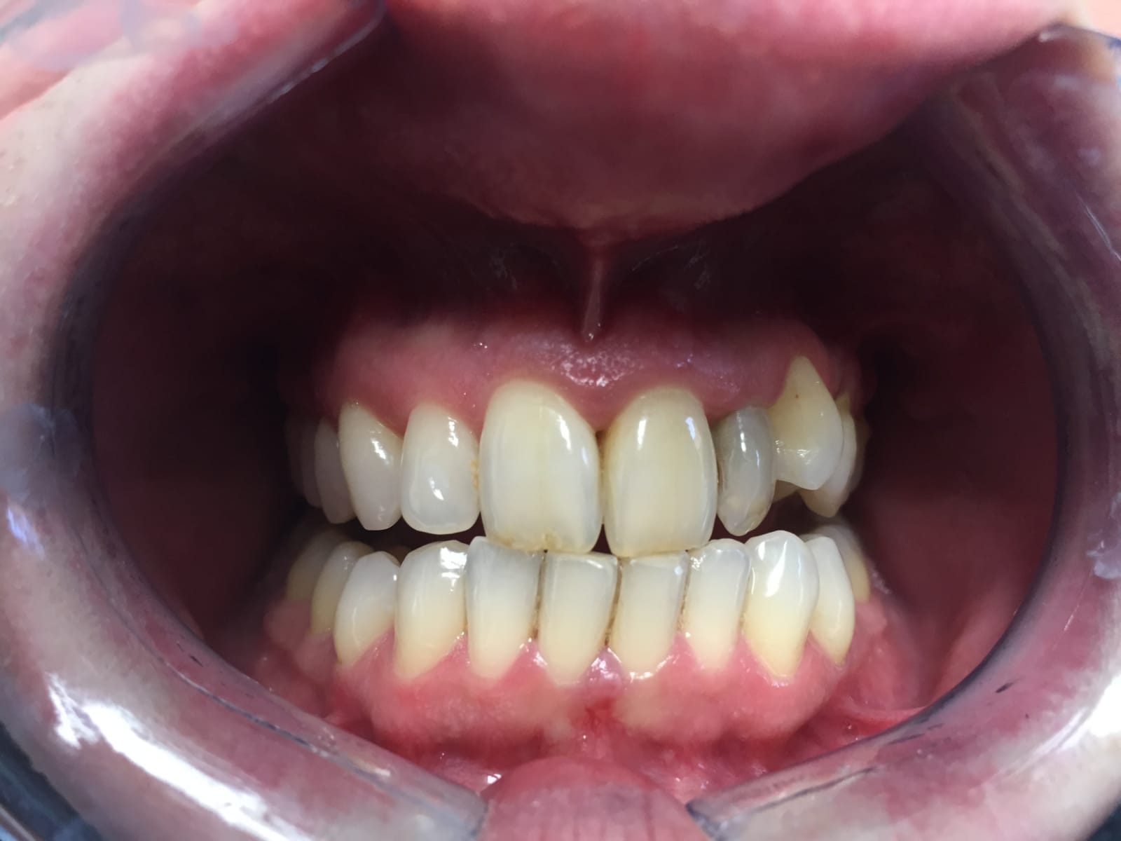 Home Teeth Whitening Before Case 2