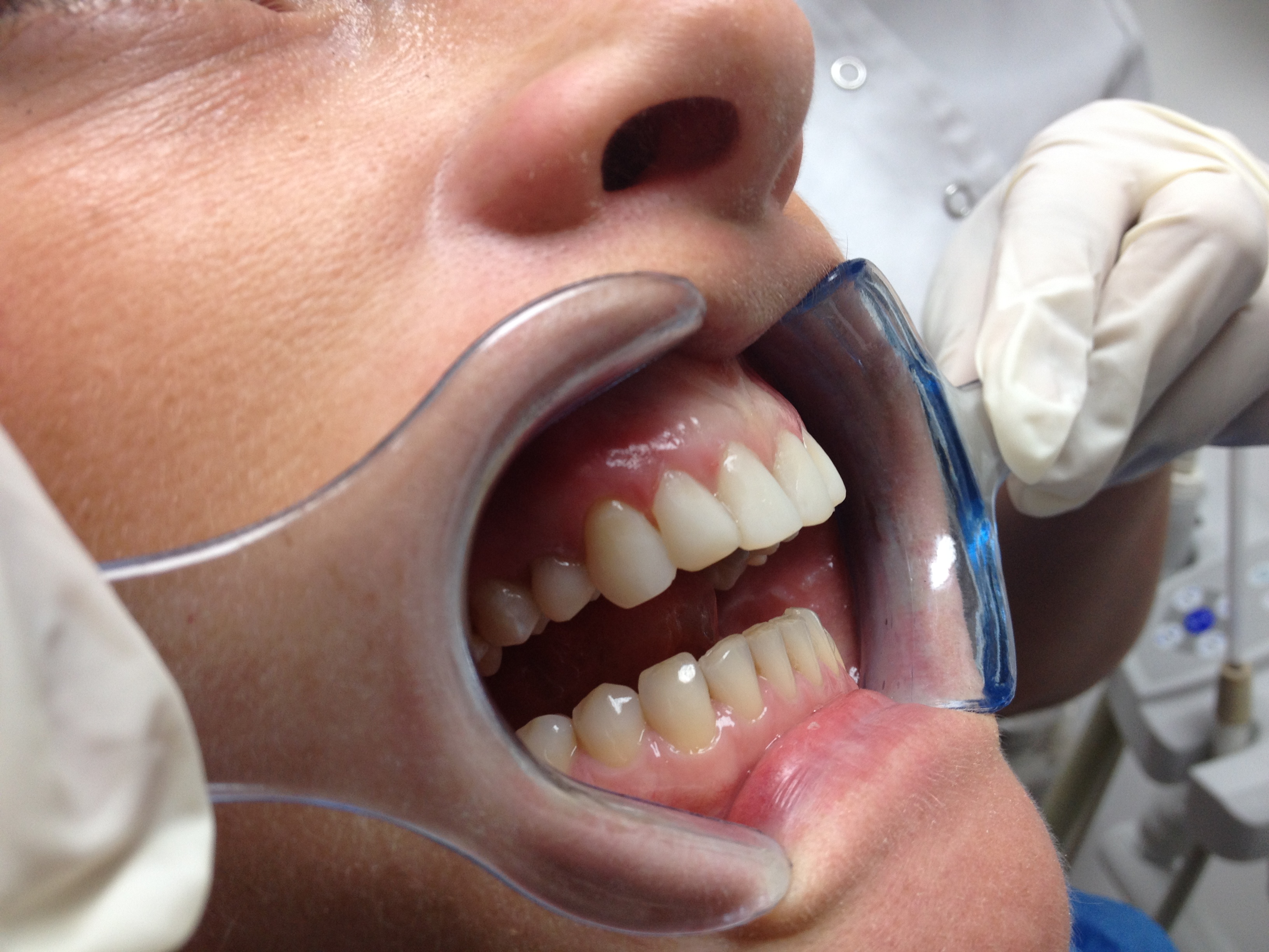 Composite Bonding After Case 1