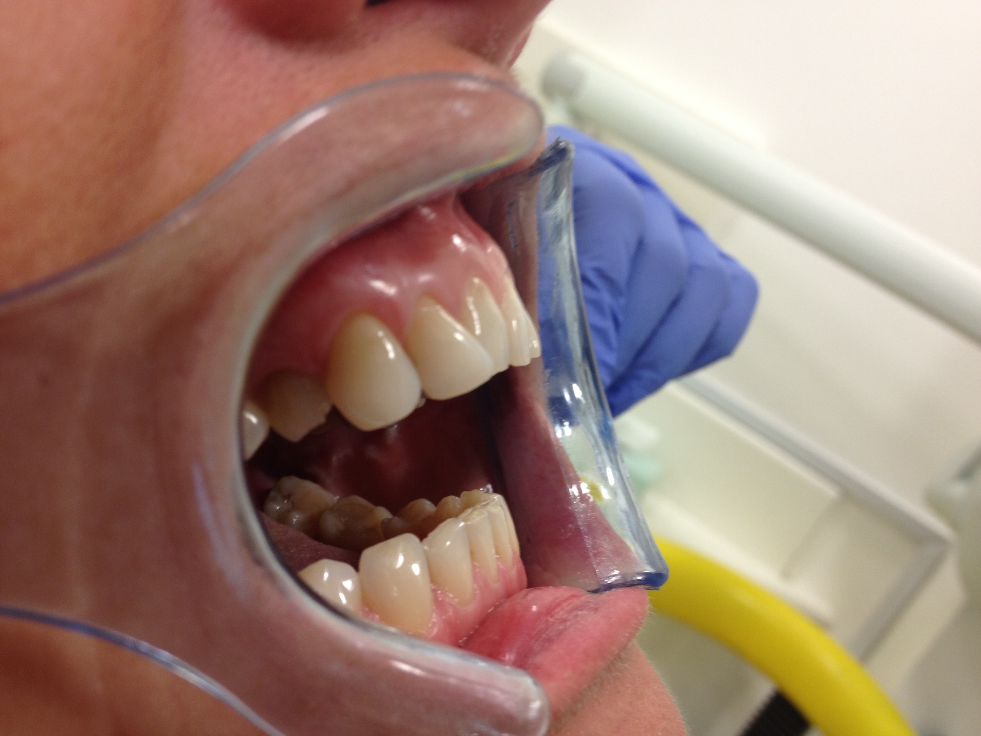 Composite Bonding Before Case 1