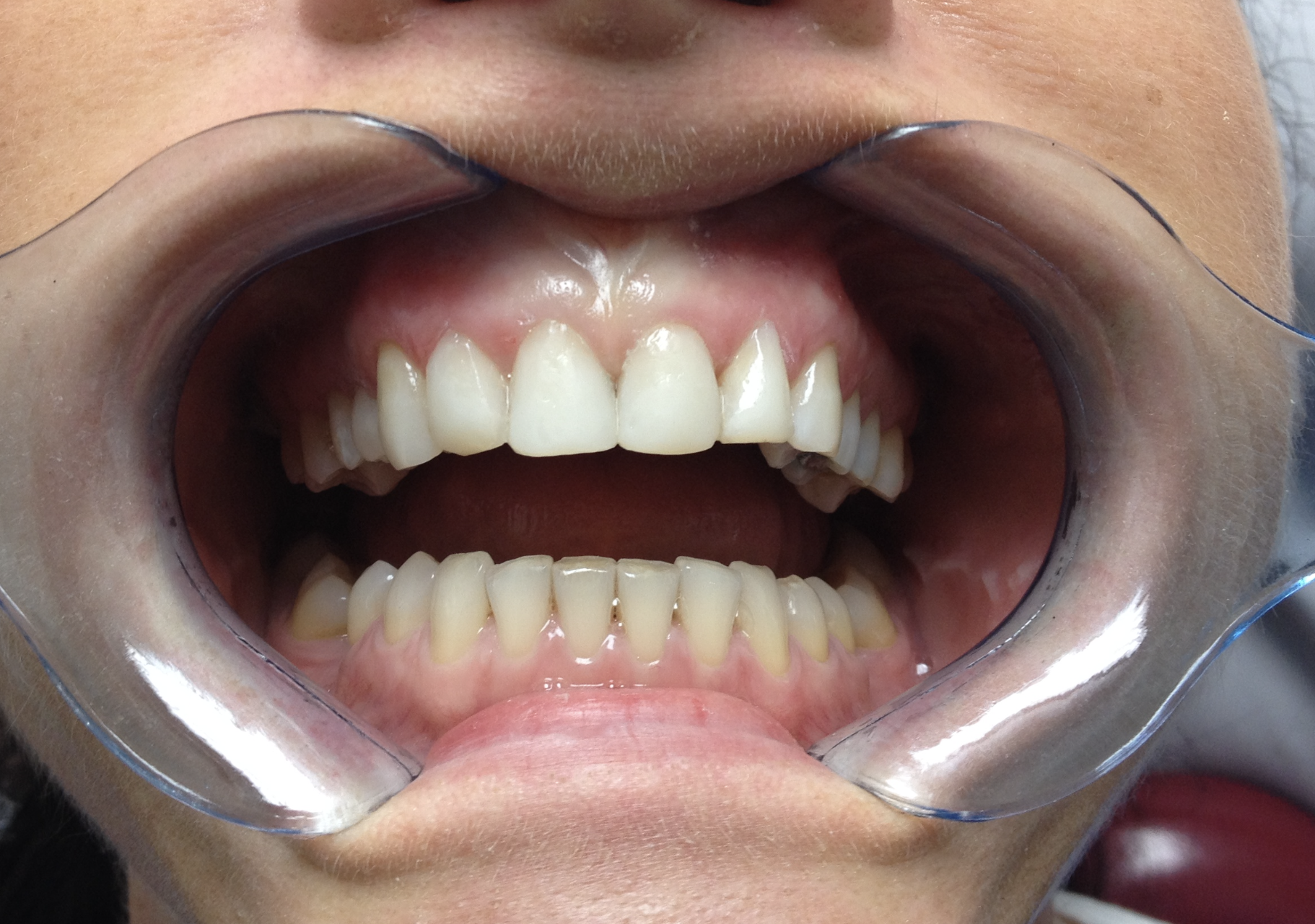 Composite Bonding After Case 2