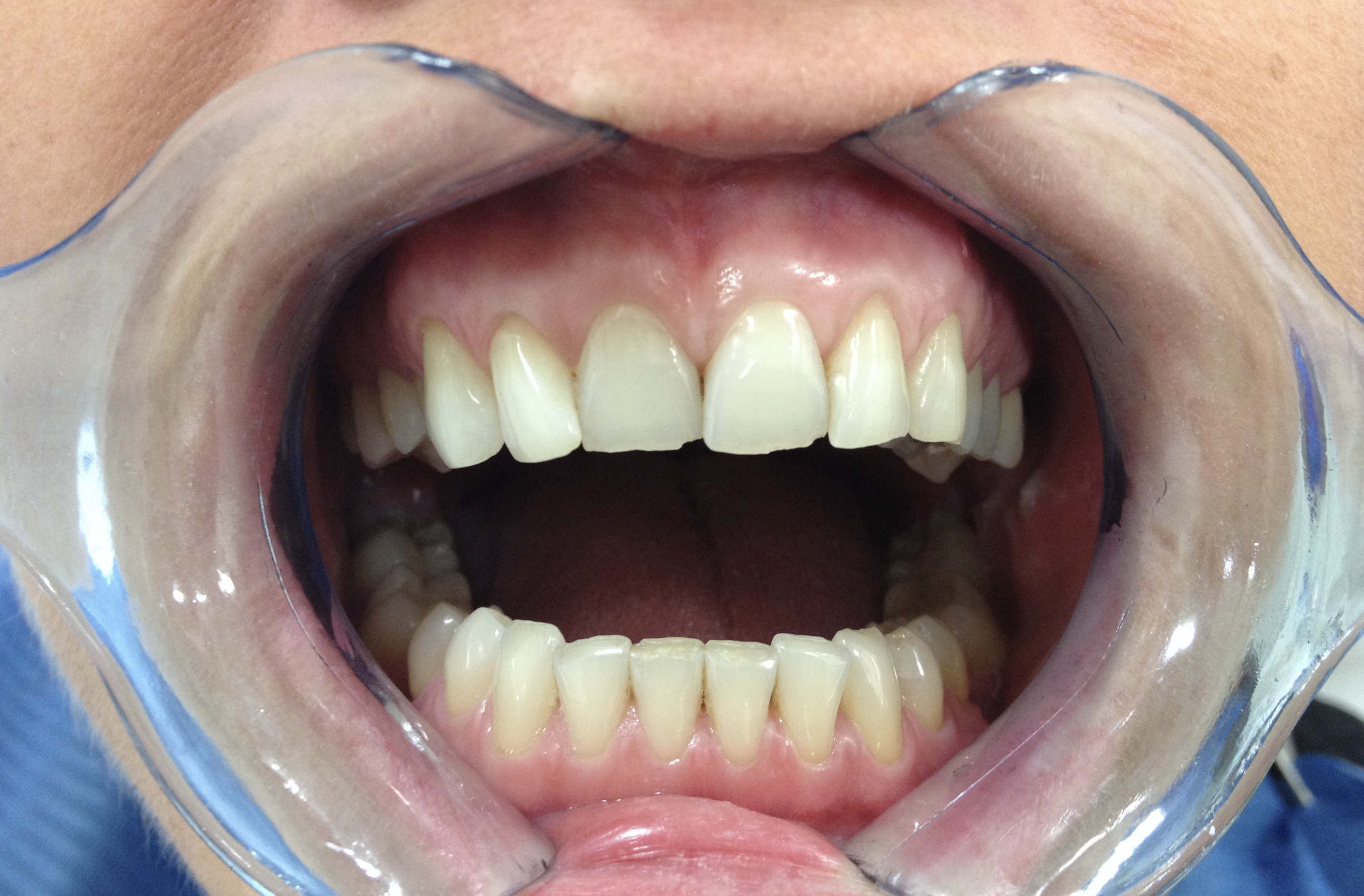 Composite Bonding Before Case 2