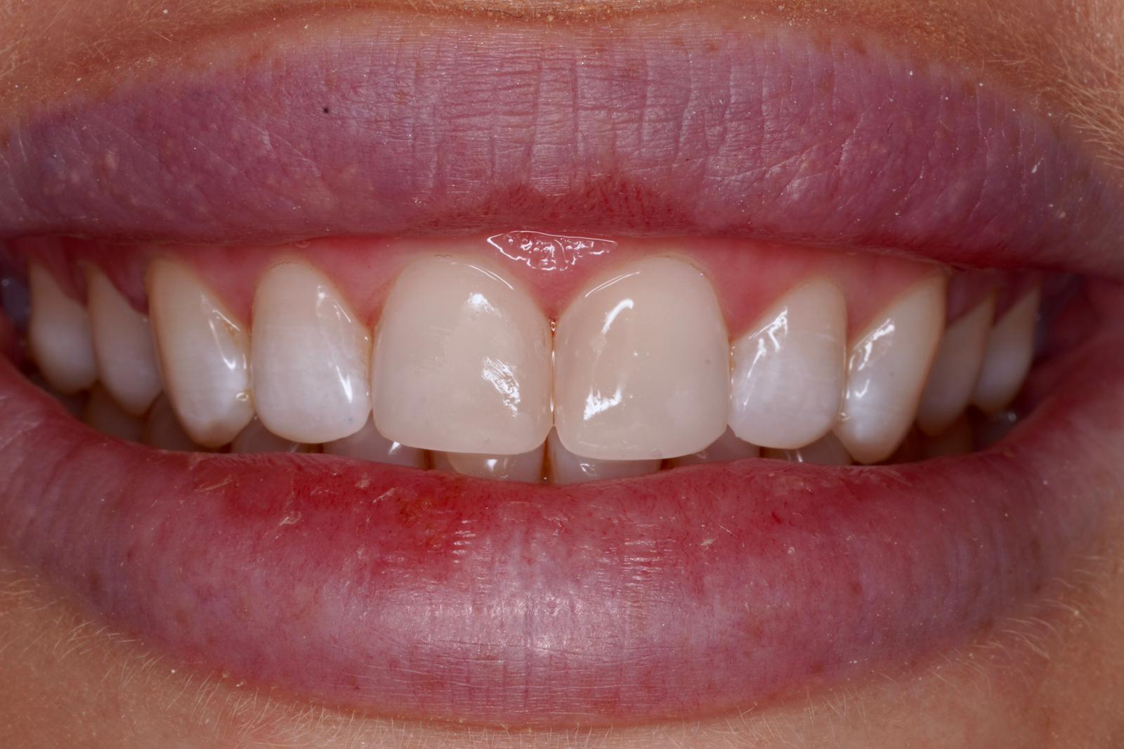 Composite Bonding After Case 3