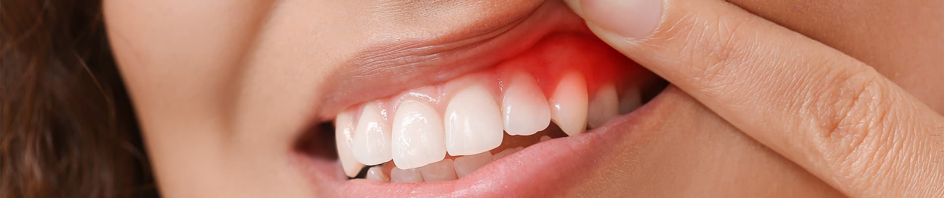 Swollen Gums: Causes, Treatment & Prevention - Conditions article