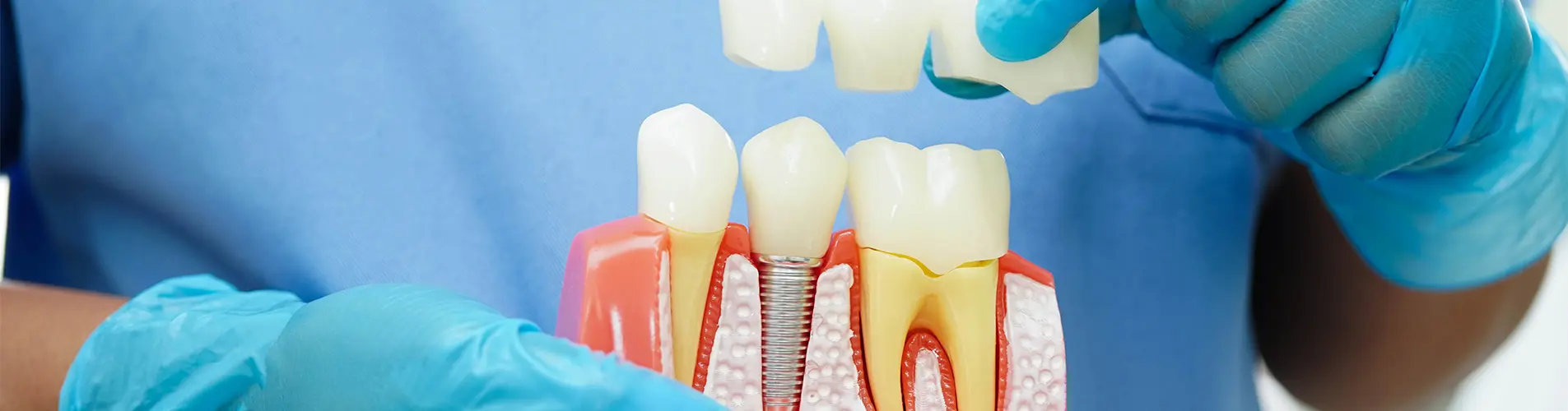 Single Tooth Replacement: Bridge or Implant?
