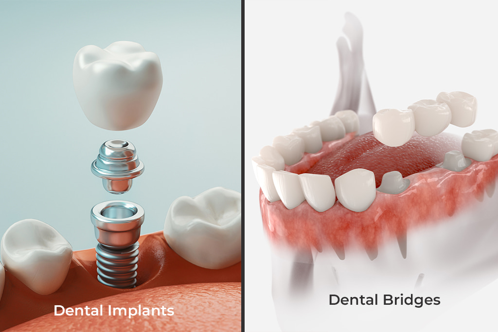 Dental Bridges vs Dental Implants: Which is the Right Tooth Replacement Option for You